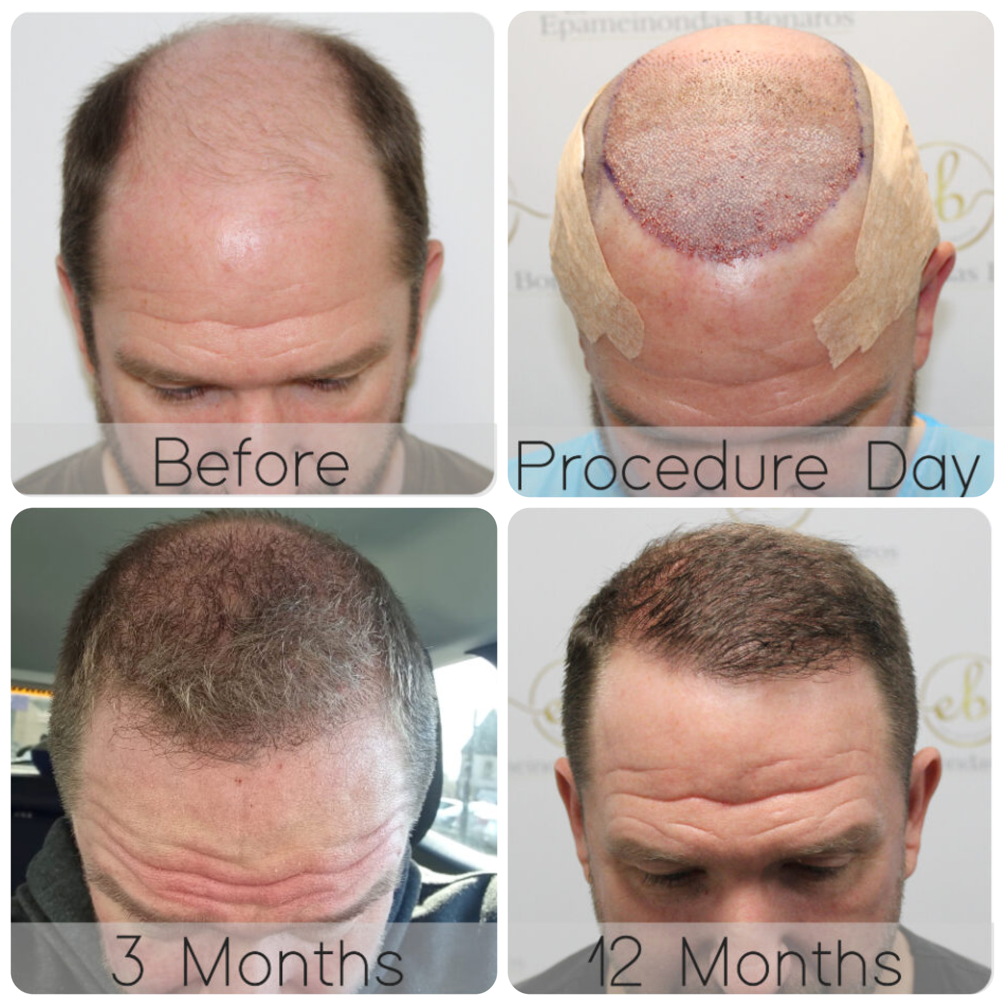 FUE hair transplant with 3,796 grafts