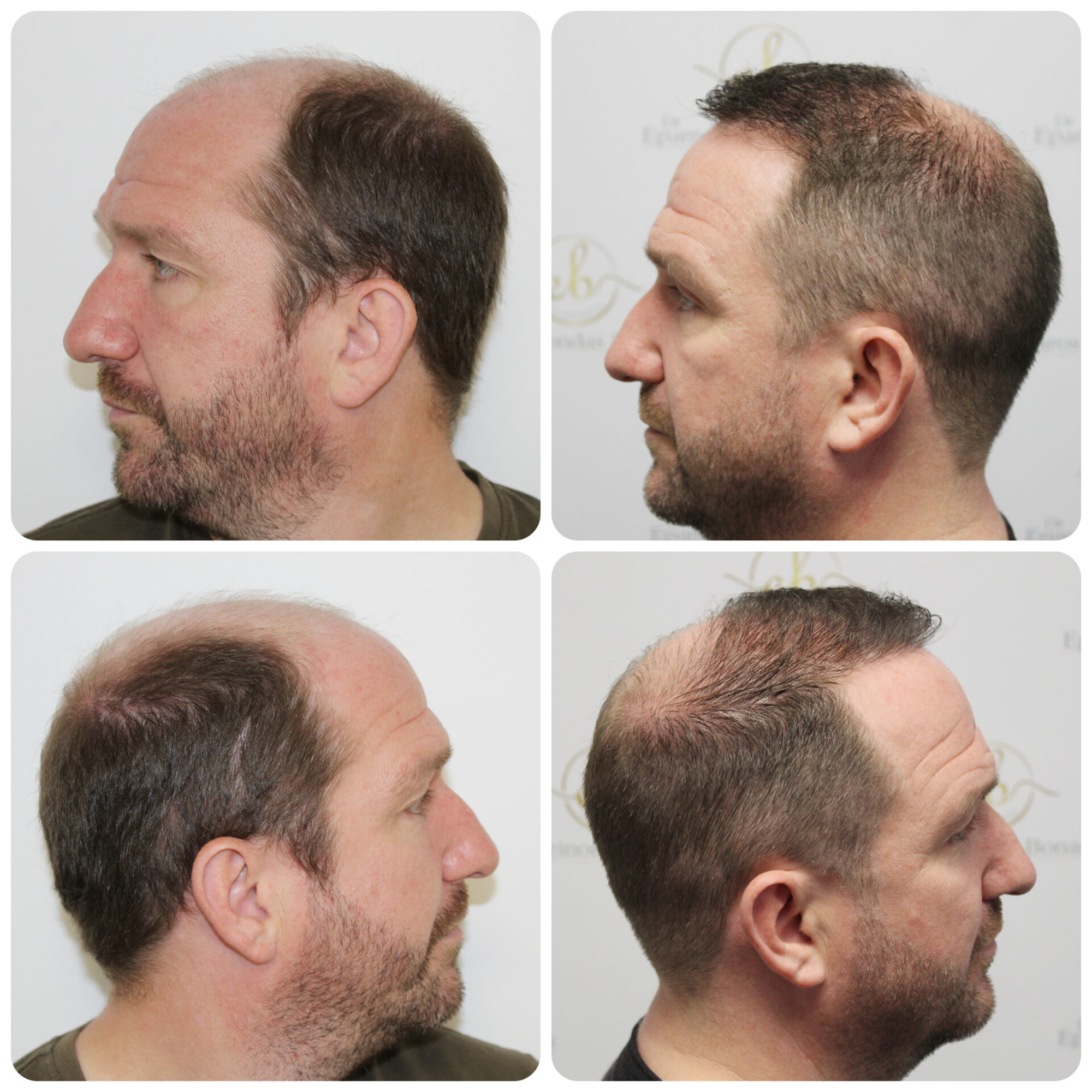 FUE hair transplant with 3,796 grafts