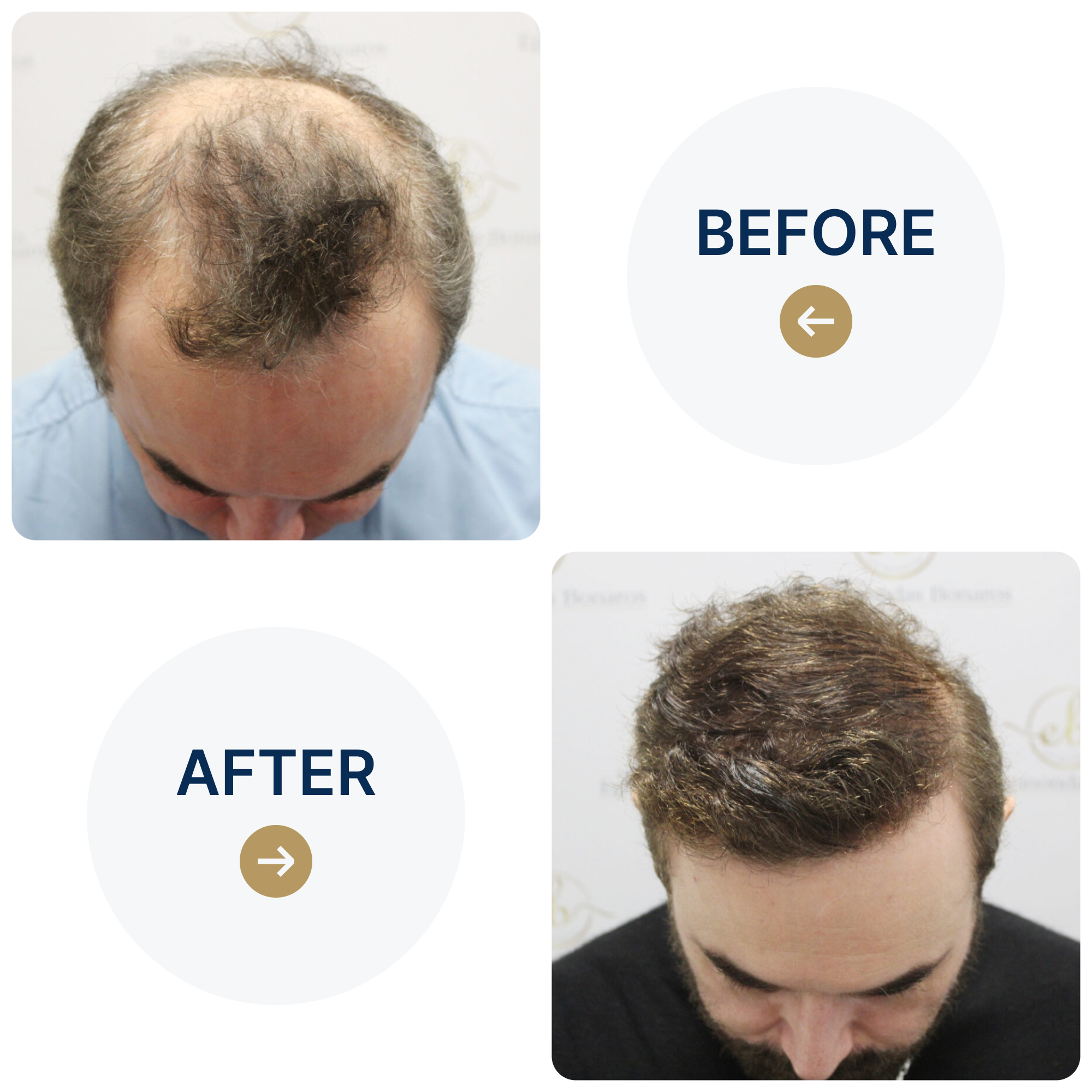 FUE hair transplant with 3,986 grafts
