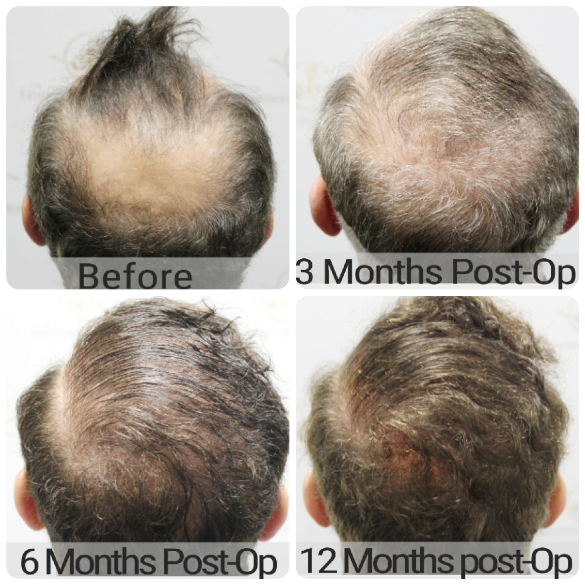 FUE hair transplant with 3,986 grafts