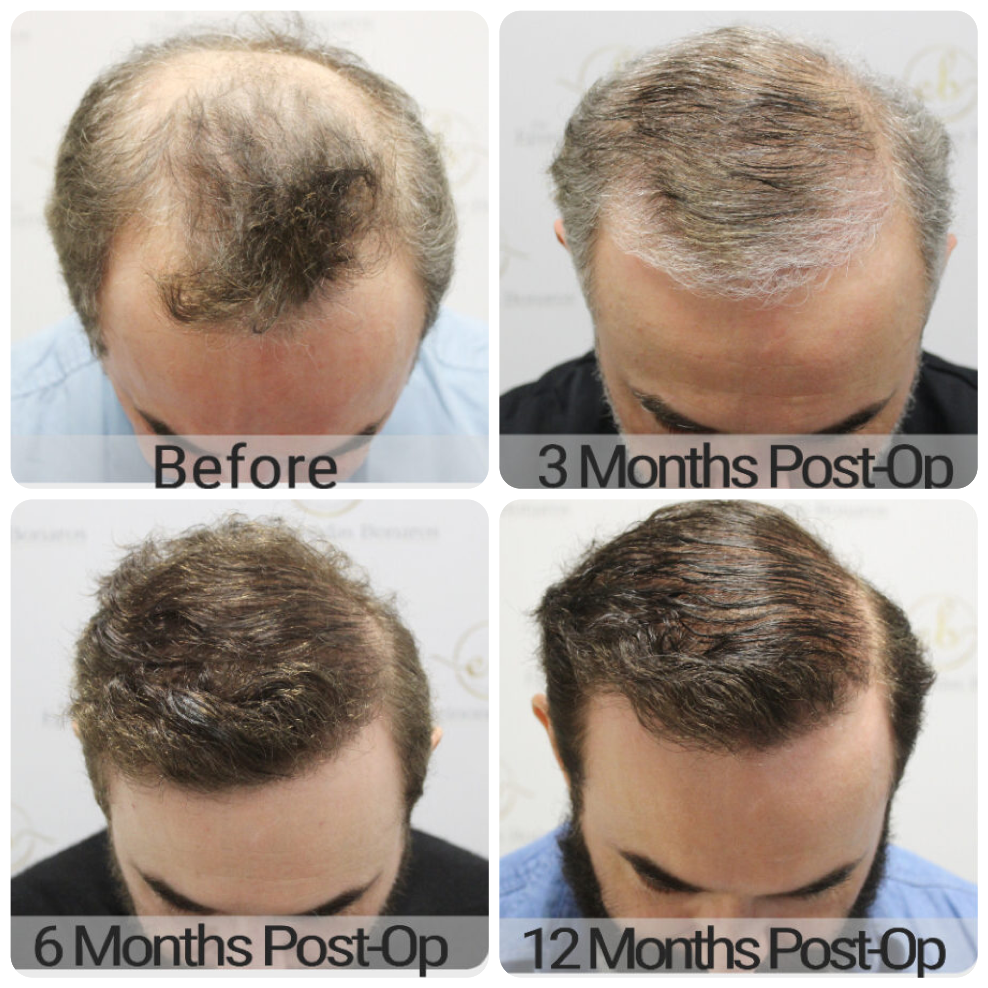 FUE hair transplant with 3,986 grafts