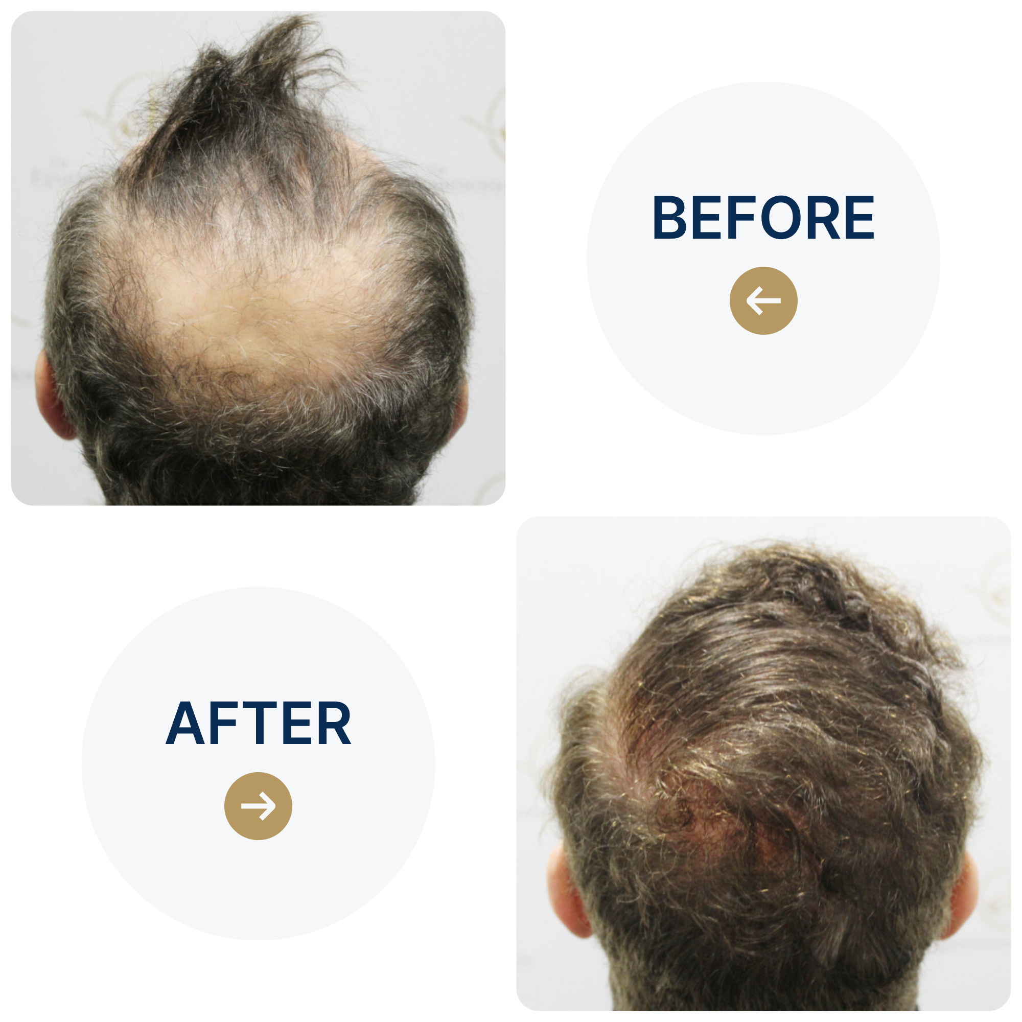 FUE hair transplant with 3,986 grafts