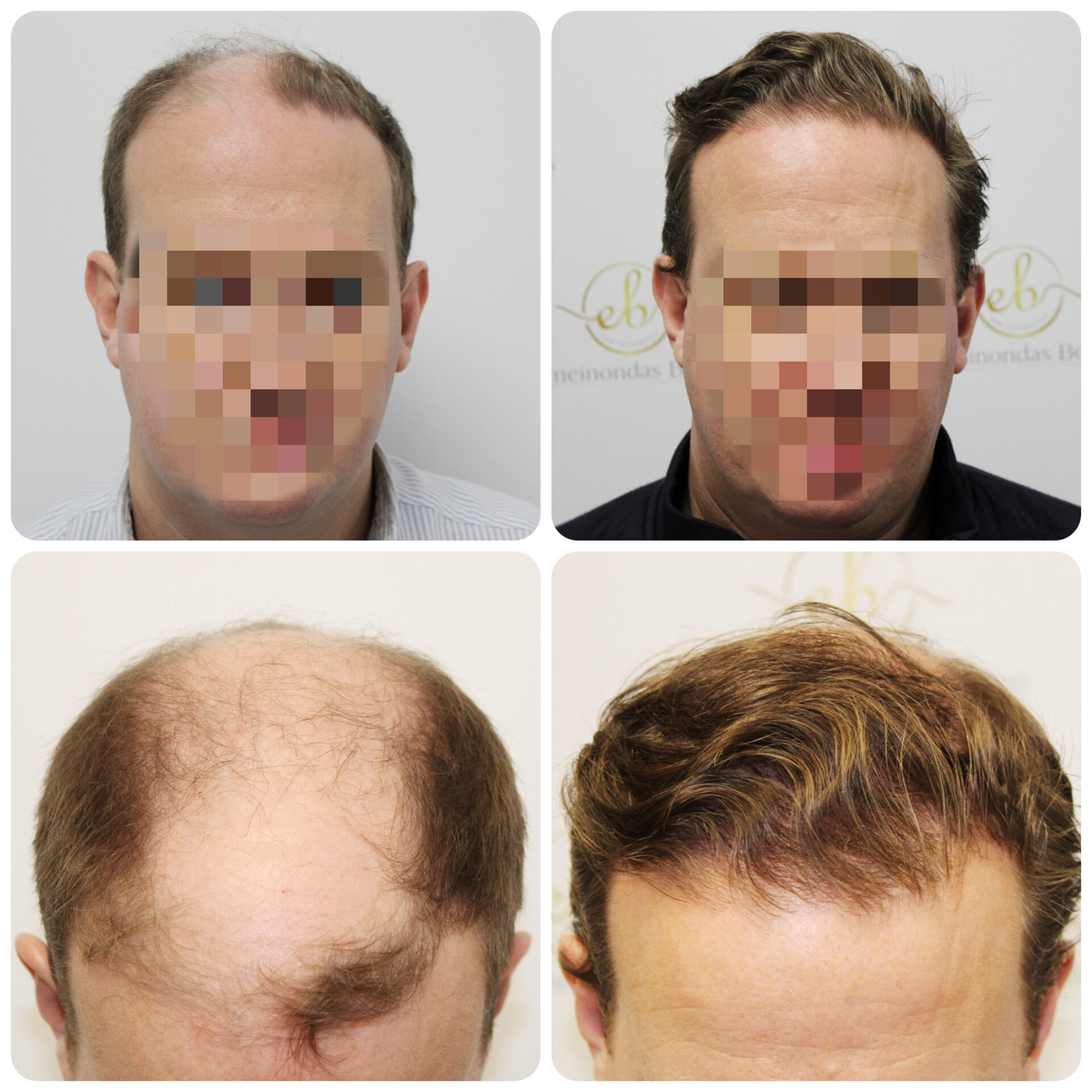 FUE procedure with 4,012 grafts