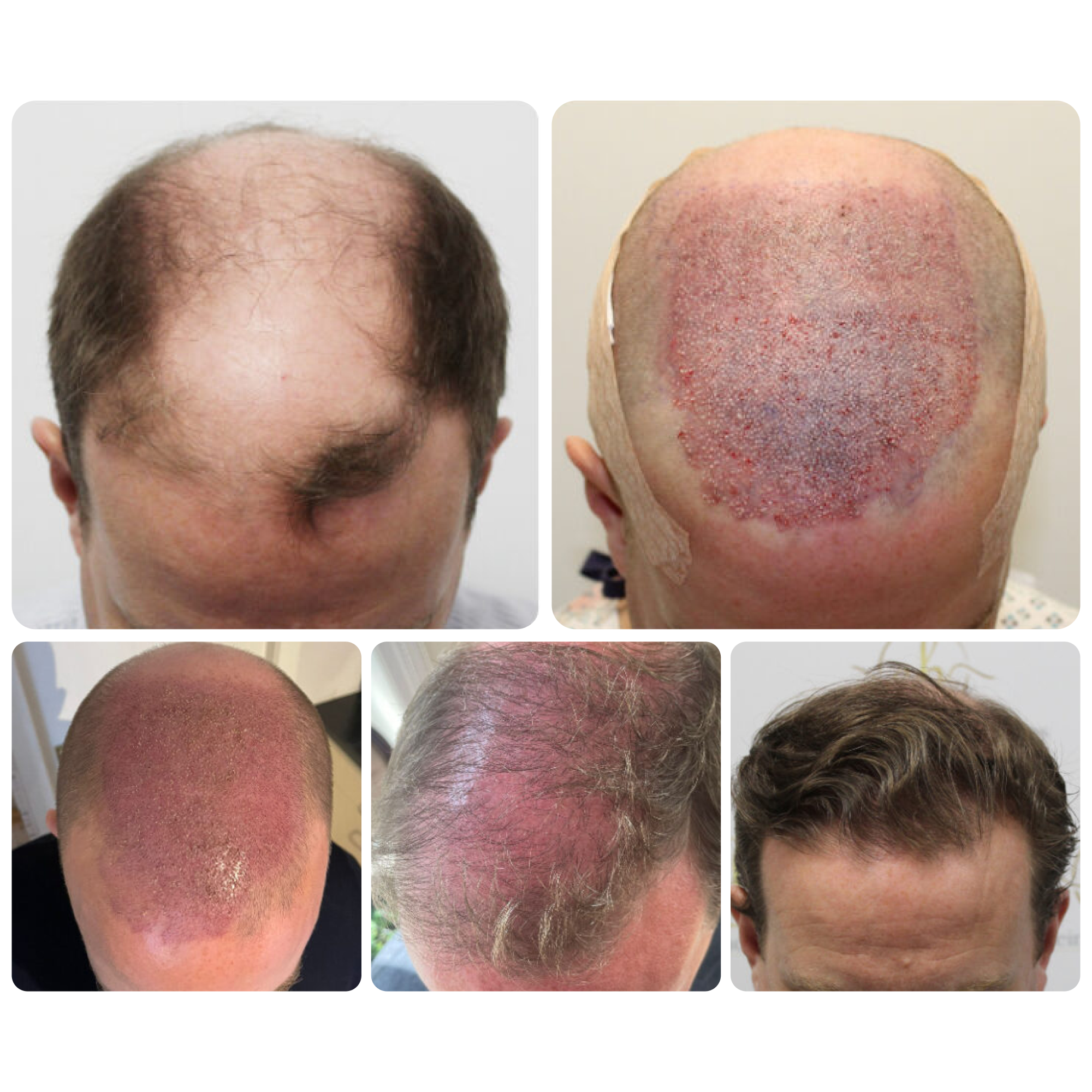 FUE procedure with 4,012 grafts