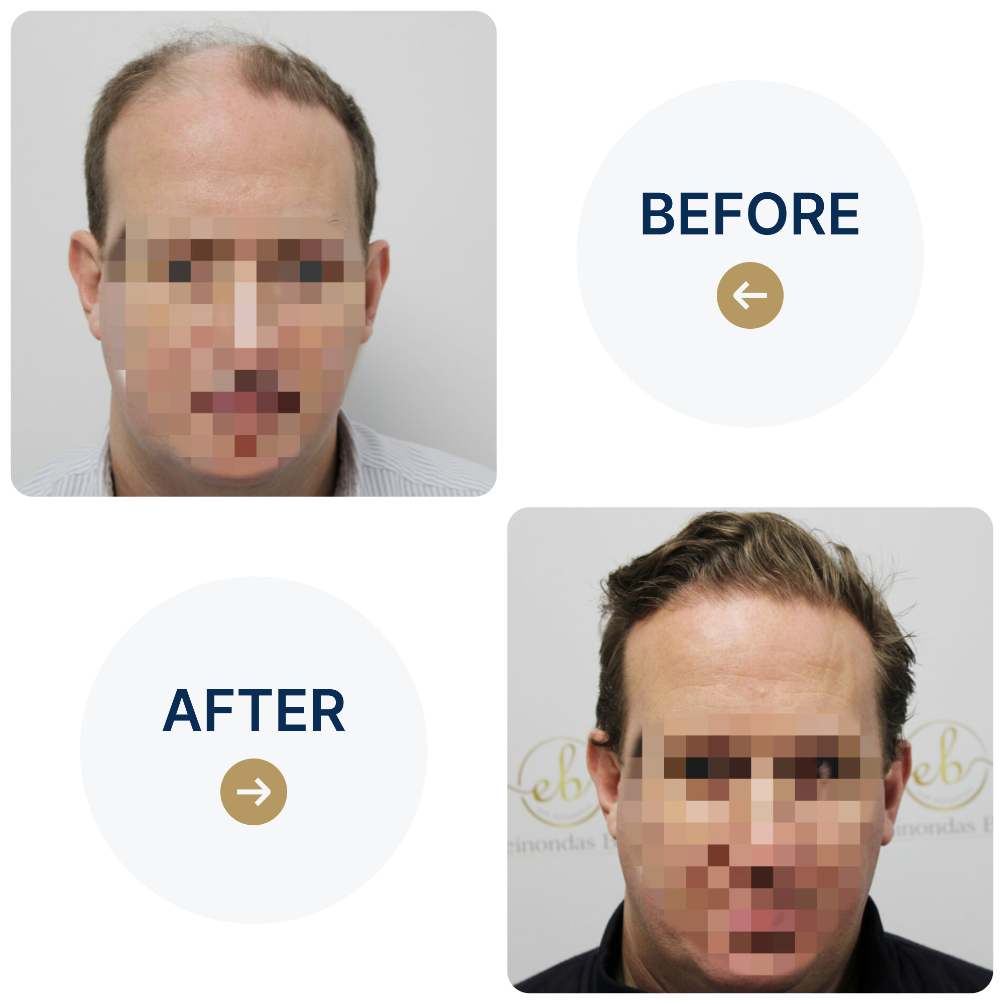 FUE procedure with 4,012 grafts