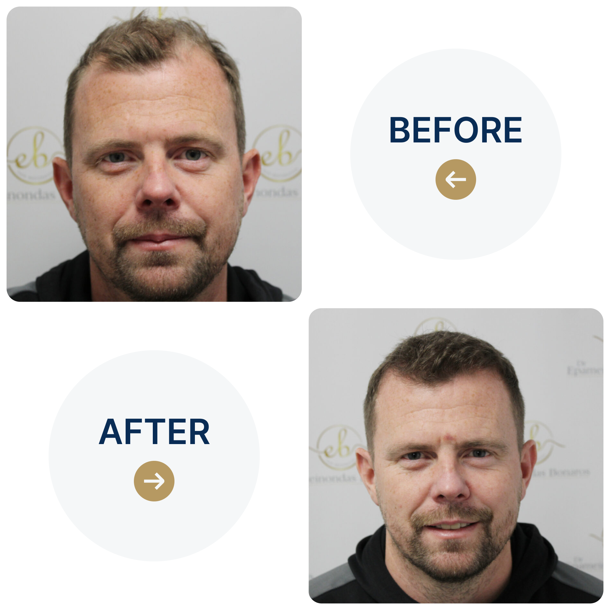 FUE procedure with 4,049 grafts