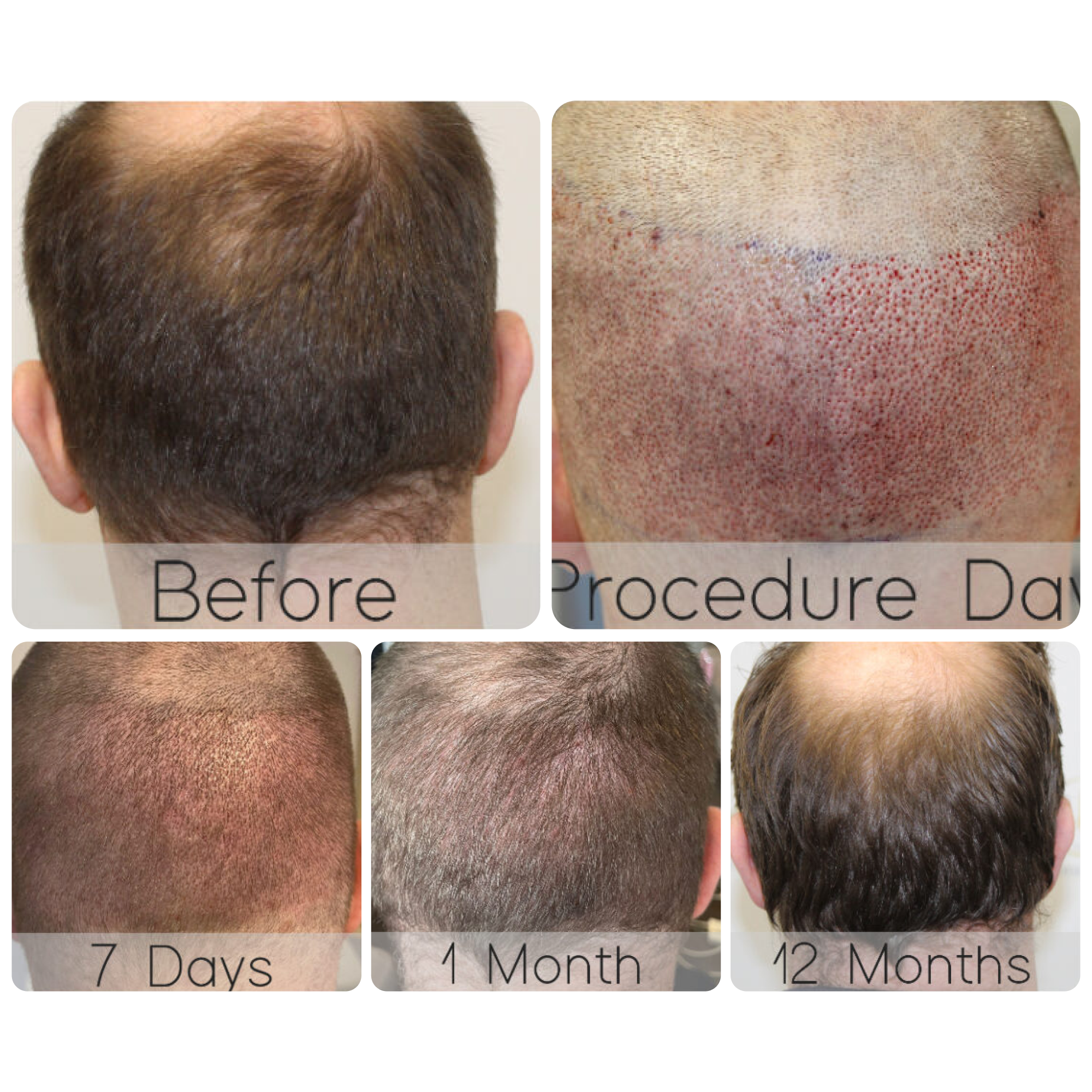 FUE procedure with 4,049 grafts