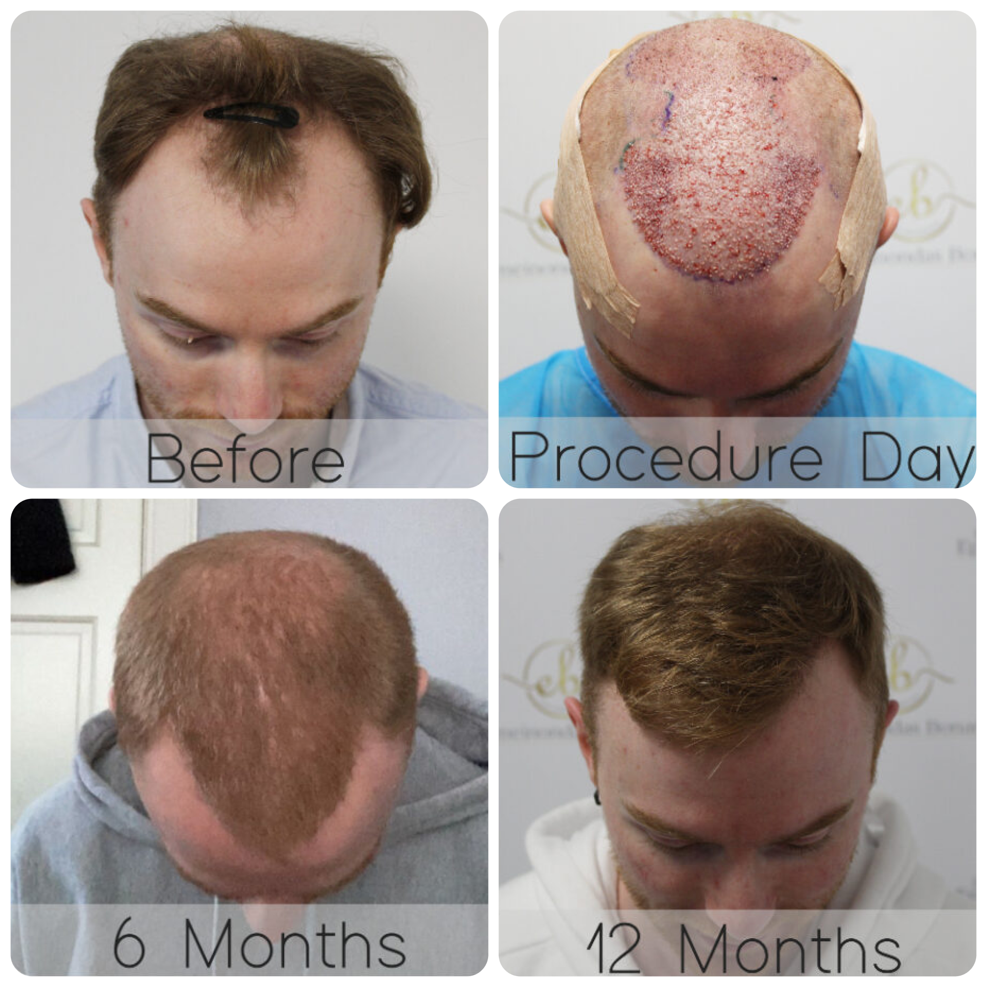 FUE procedure with 4,049 grafts
