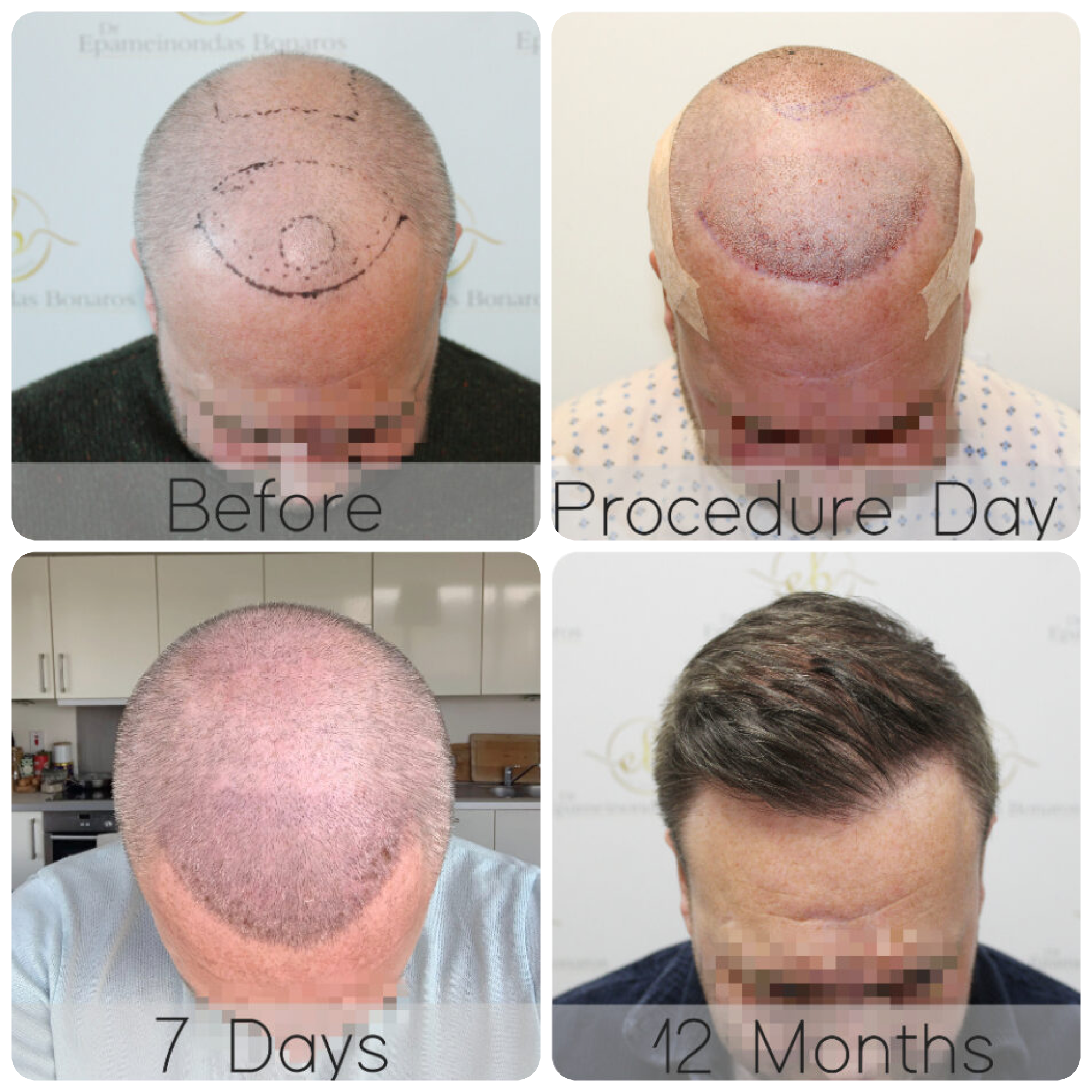 FUE procedure with 4,049 grafts