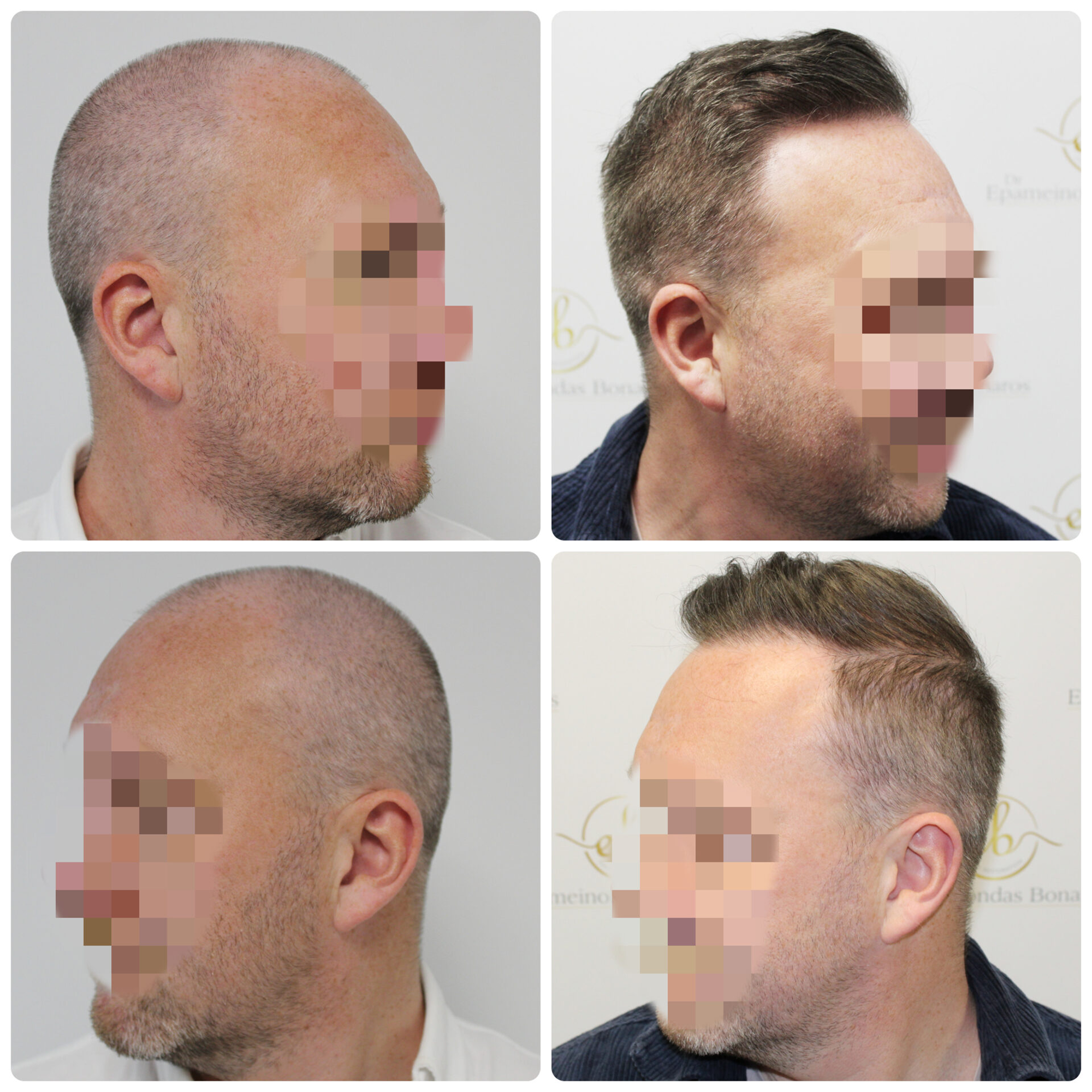 FUE procedure with 4,076 grafts