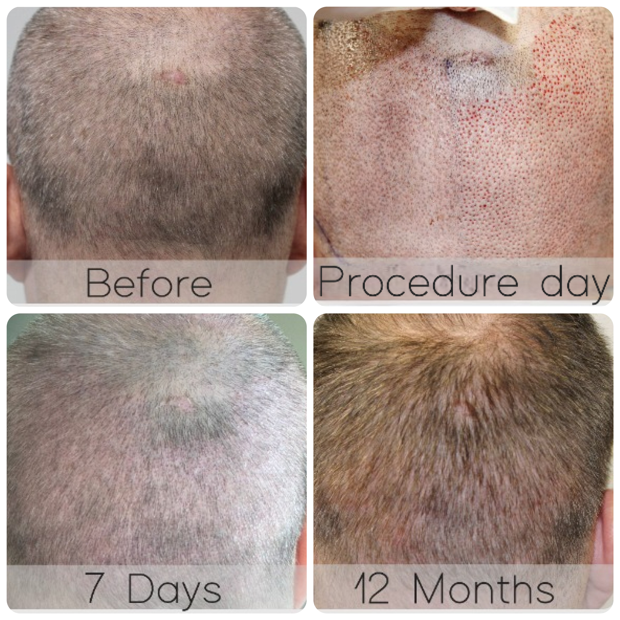 FUE procedure with 4,076 grafts