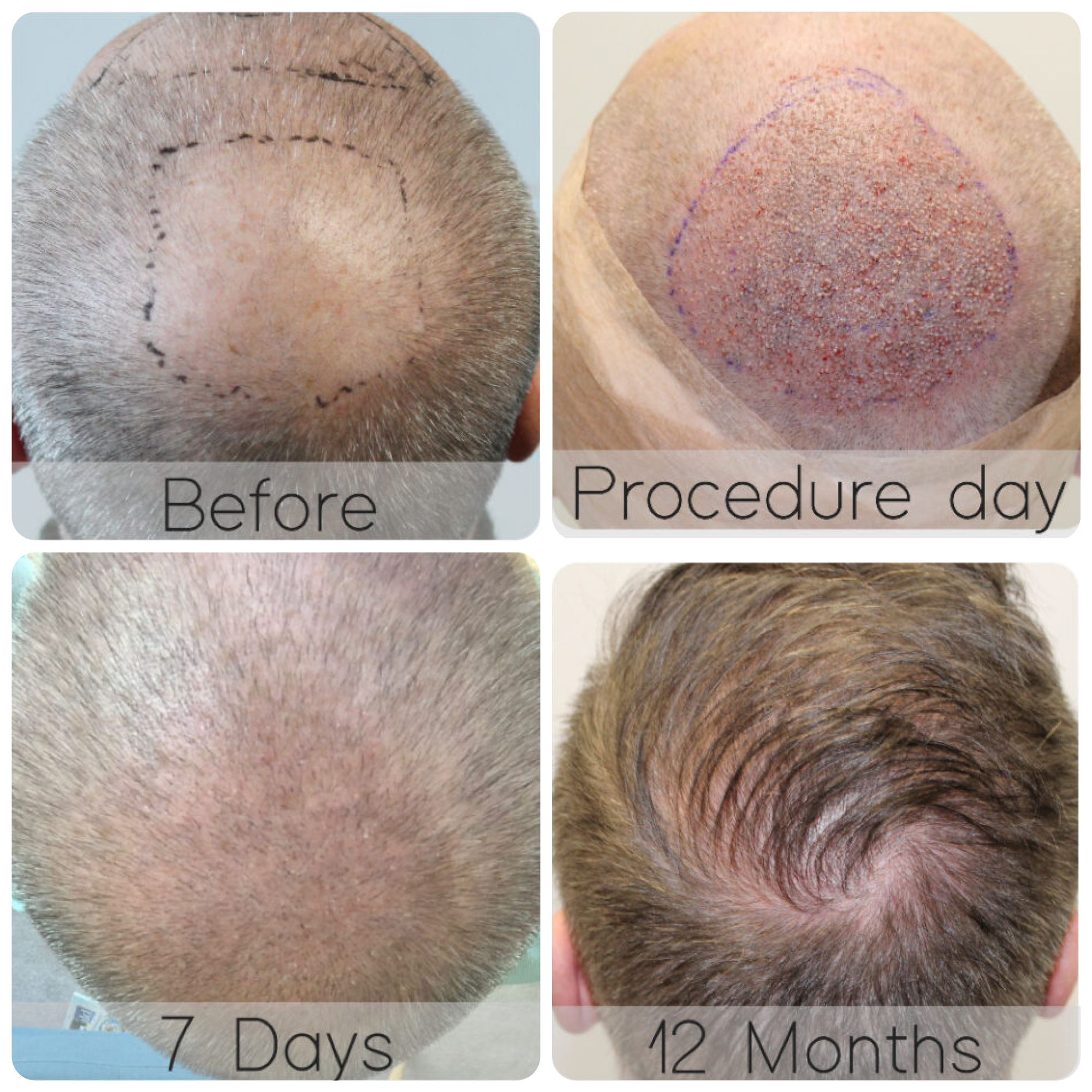 FUE procedure with 4,076 grafts