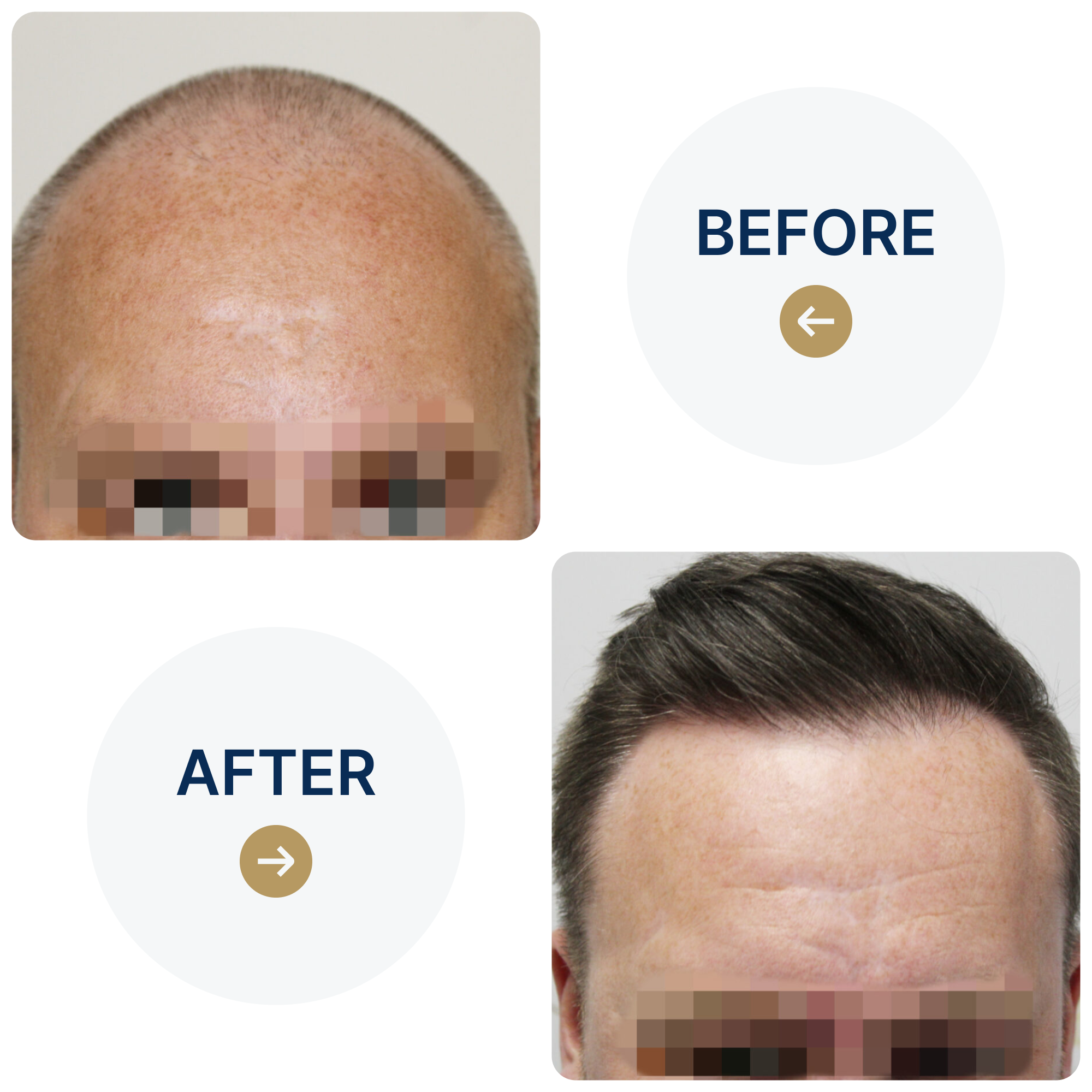 FUE procedure with 4,076 grafts