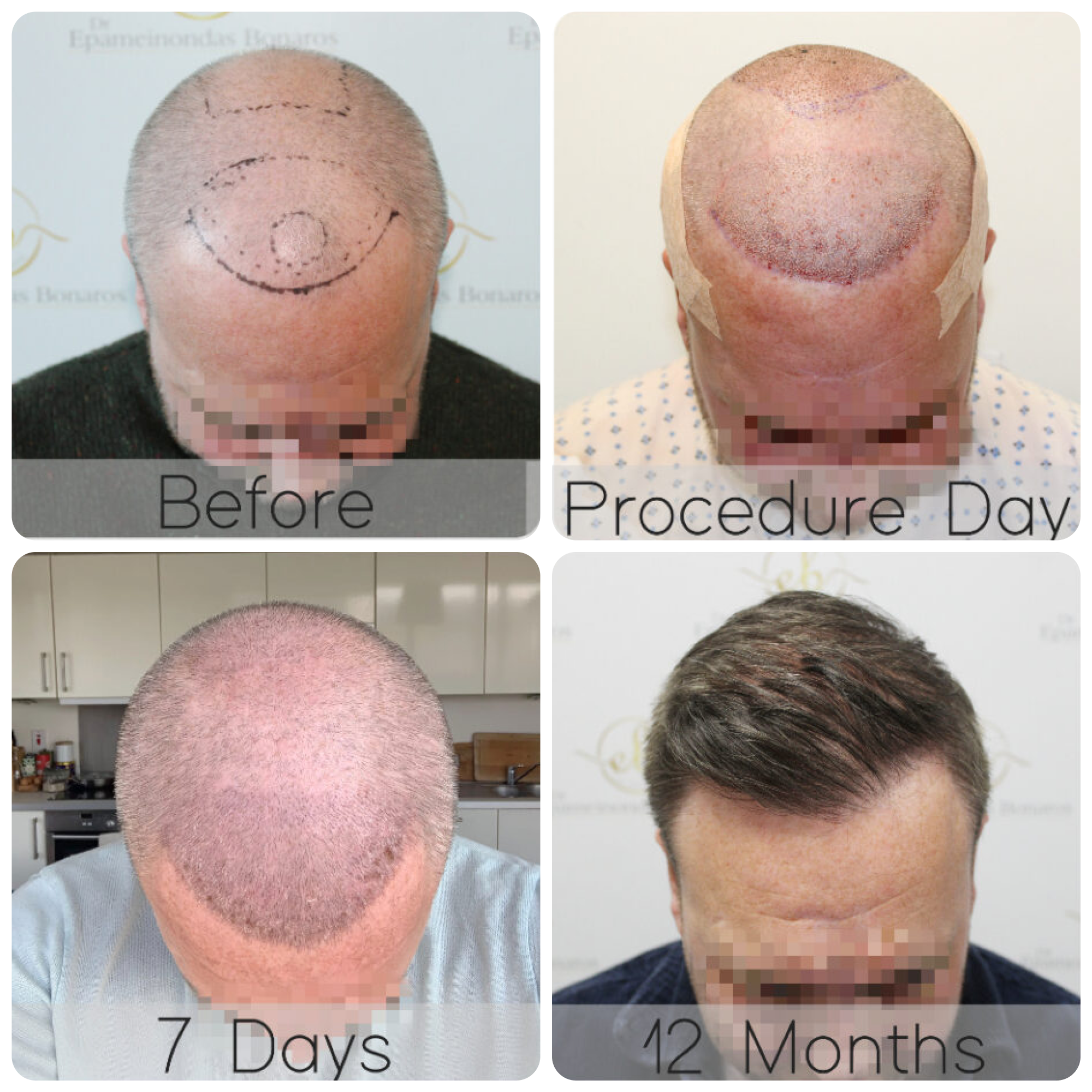 FUE procedure with 4,076 grafts