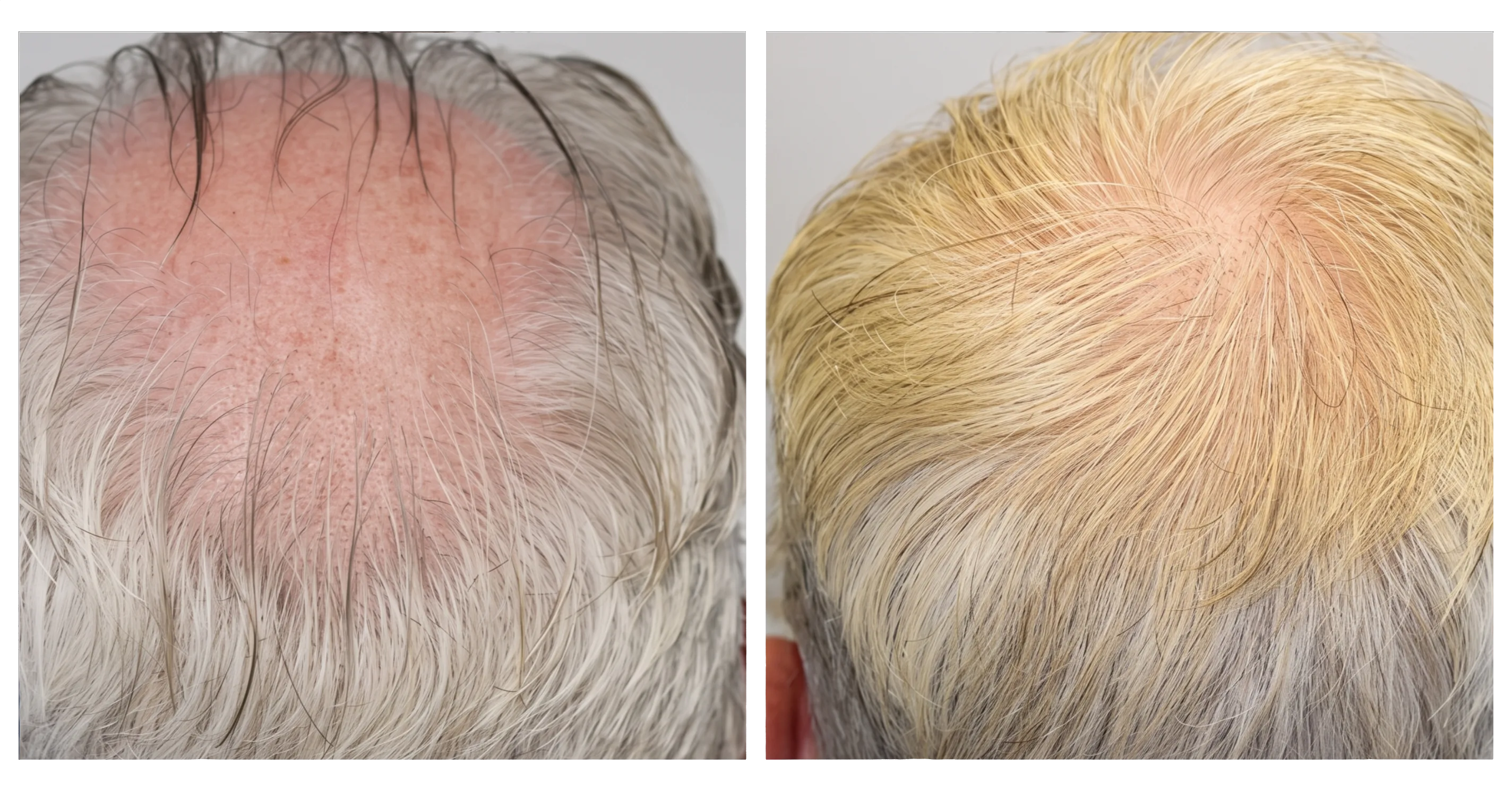 Rebuilding a receding hairline