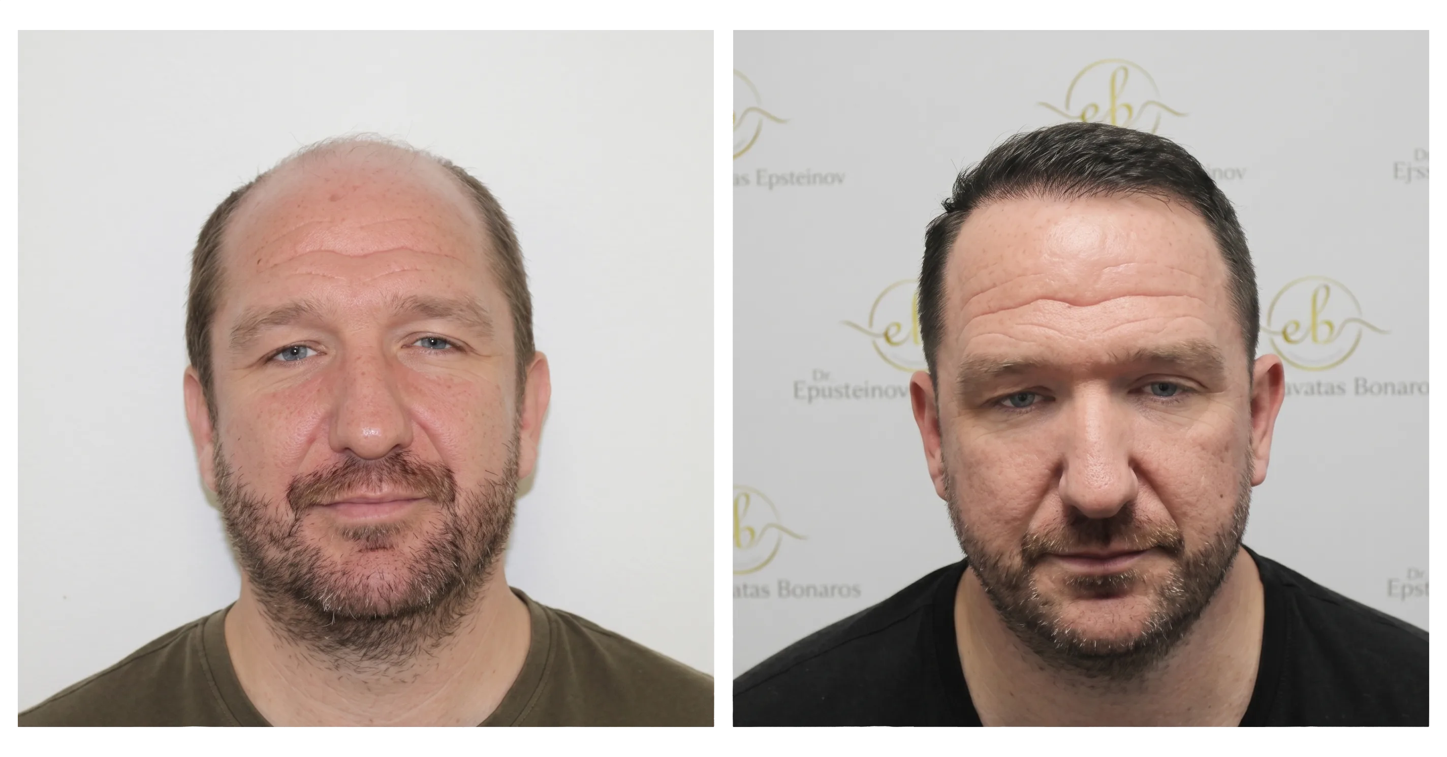 Unshaven FUE for a discreet return to work