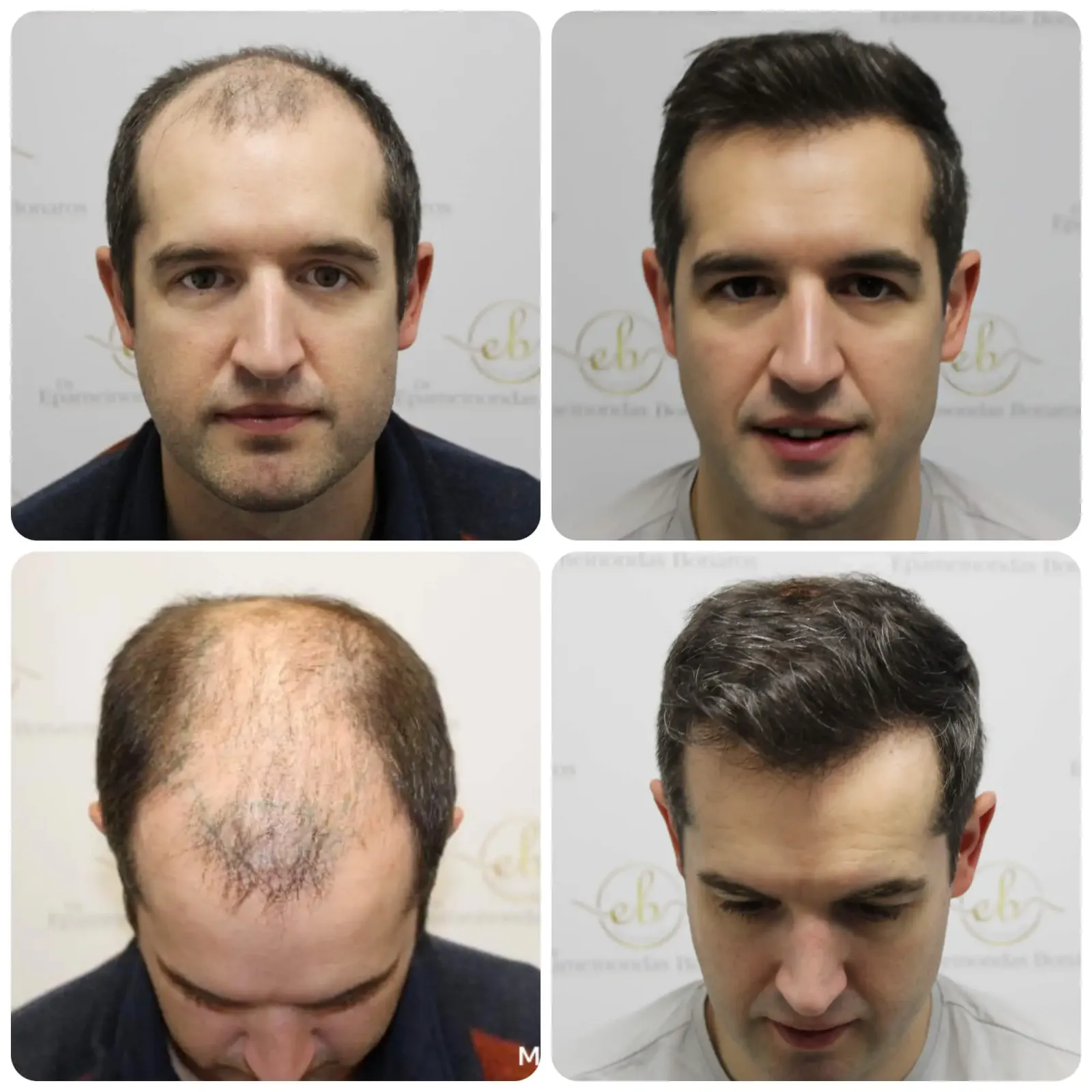 Rebuilding a receding hairline