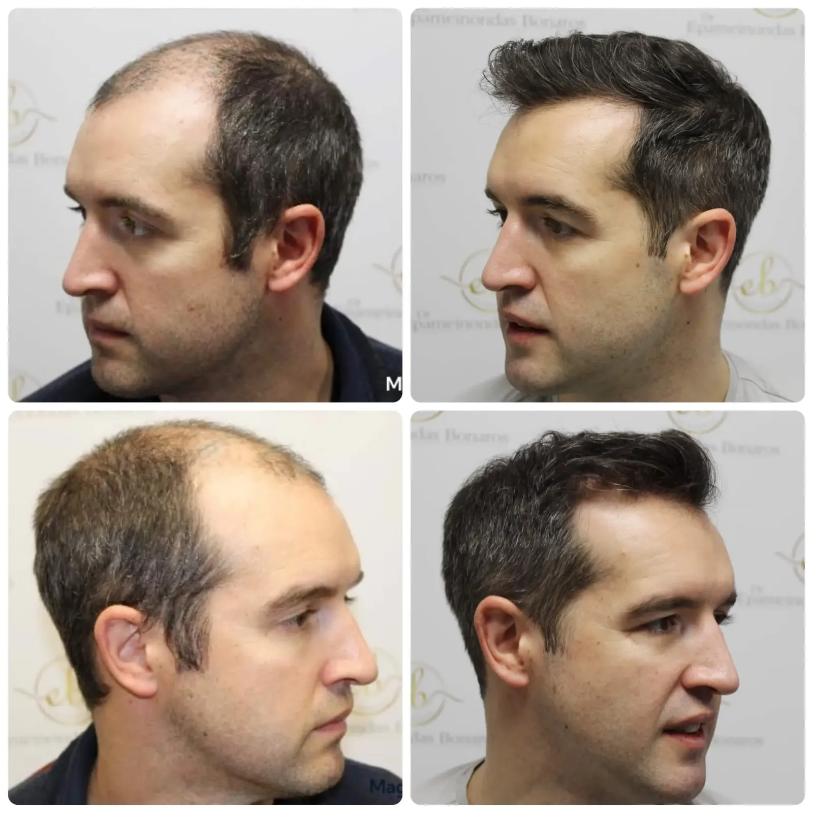 Rebuilding a receding hairline