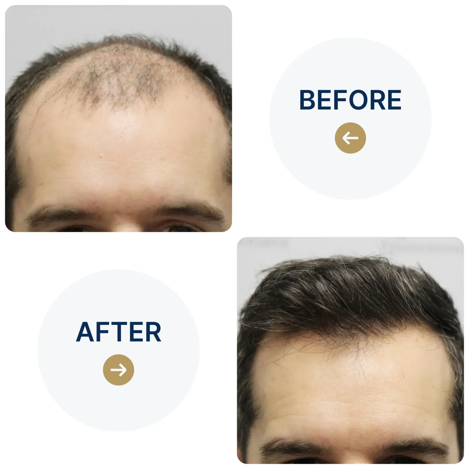 Rebuilding a receding hairline