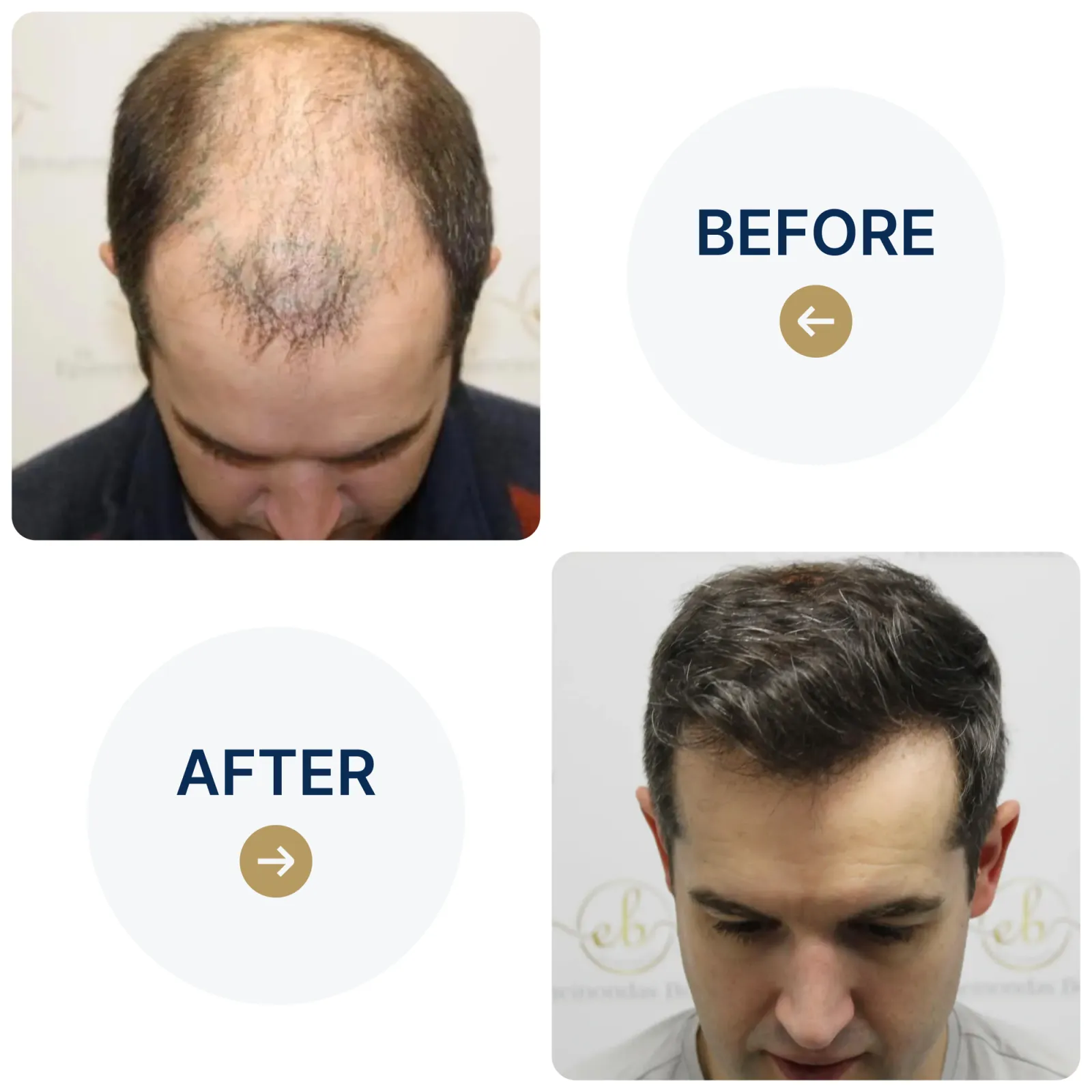 Rebuilding a receding hairline