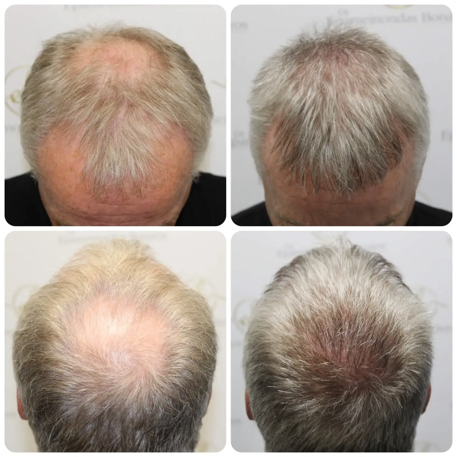 What is a crown hair transplant