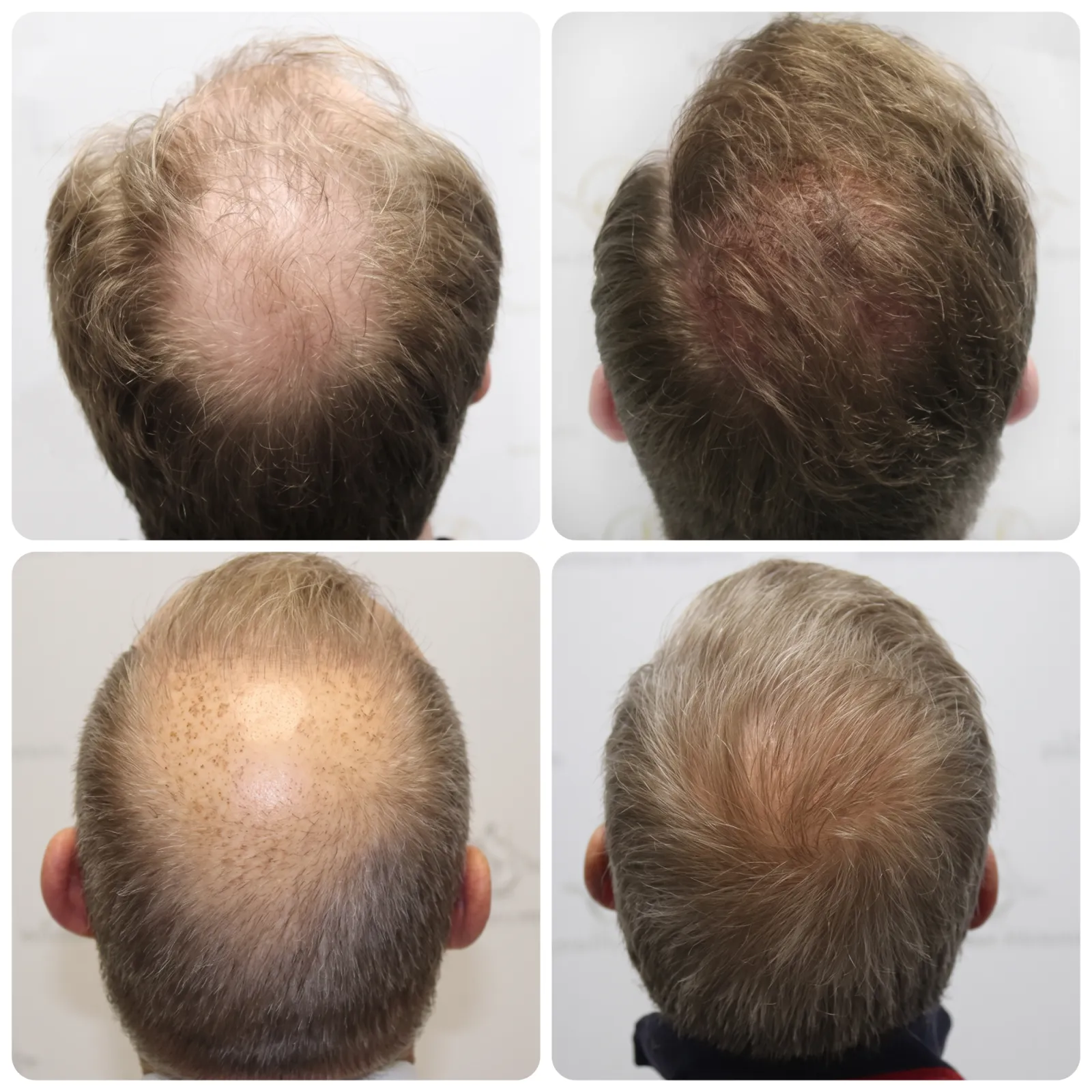 Crown hair transplant questions answered