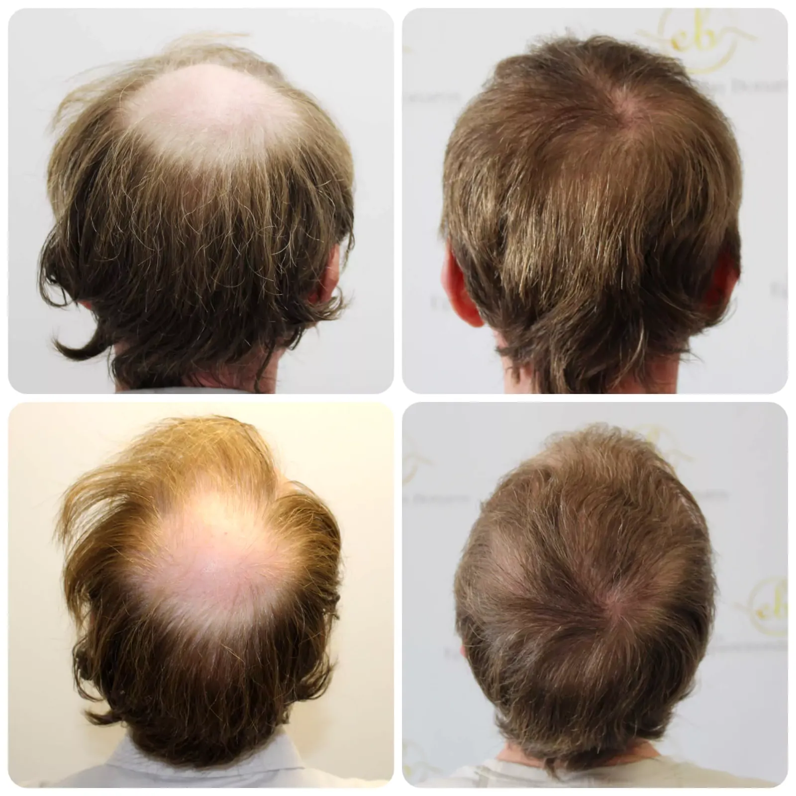 Crown after treatment