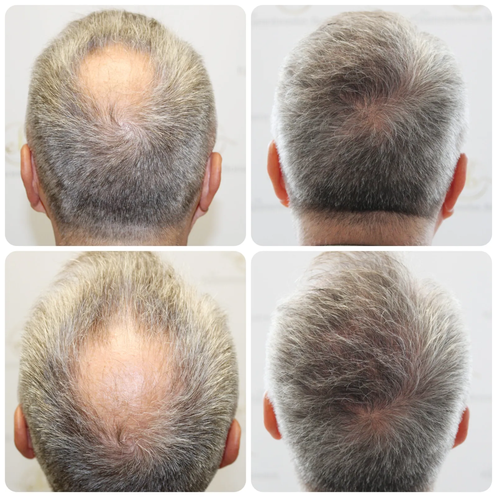 How a crown hair transplant is done