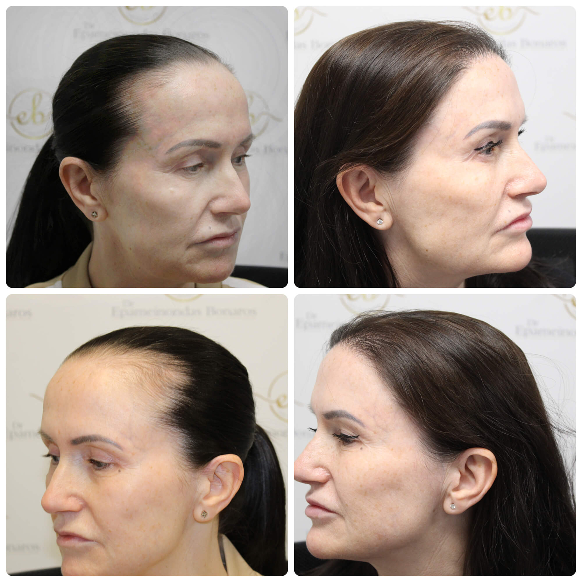 FUE hair transplant procedure for female pattern hair loss