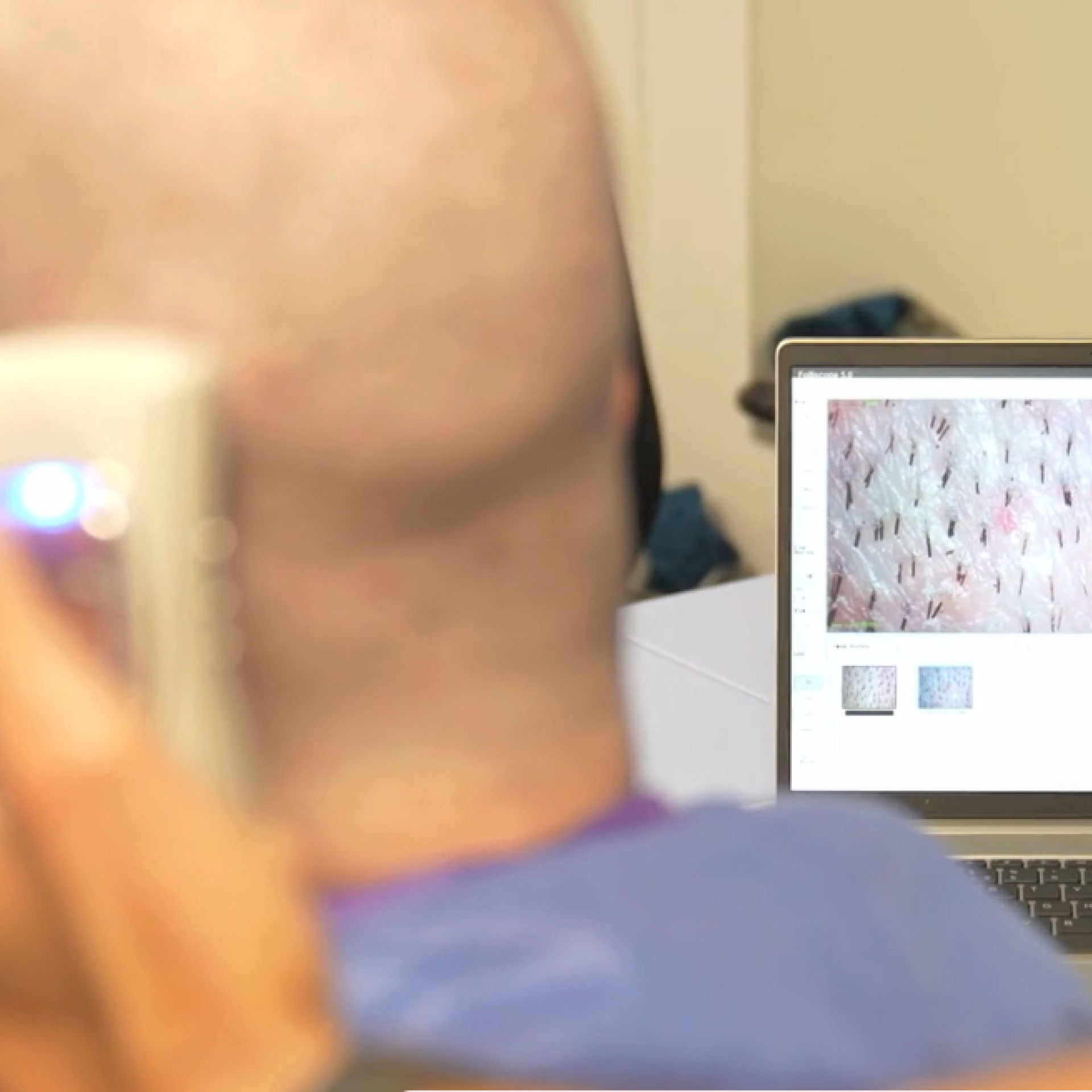Trichoscopy examination of the scalp