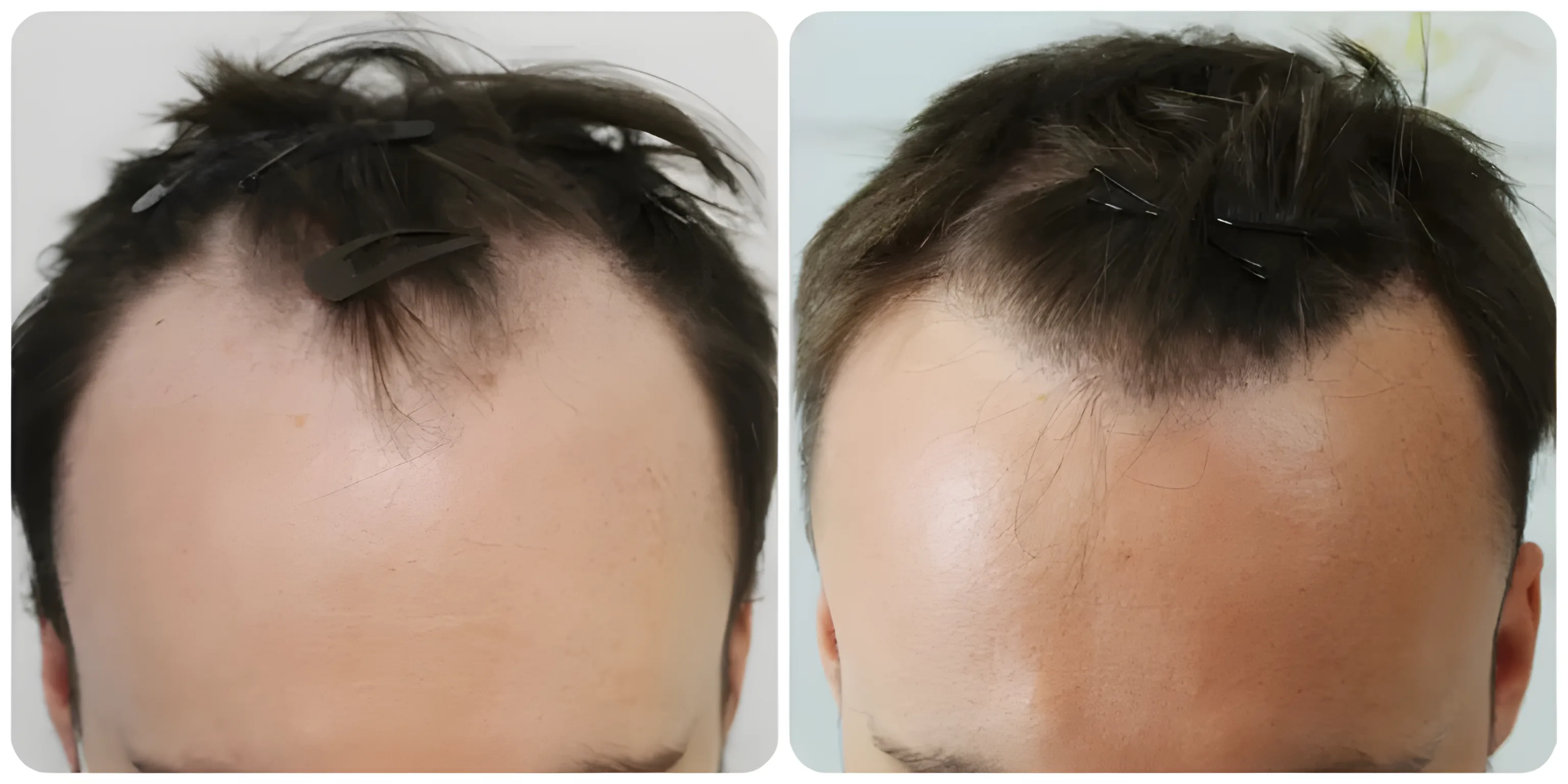 FUE hairline & frontal third — 2,019 grafts / 4,681 hairs