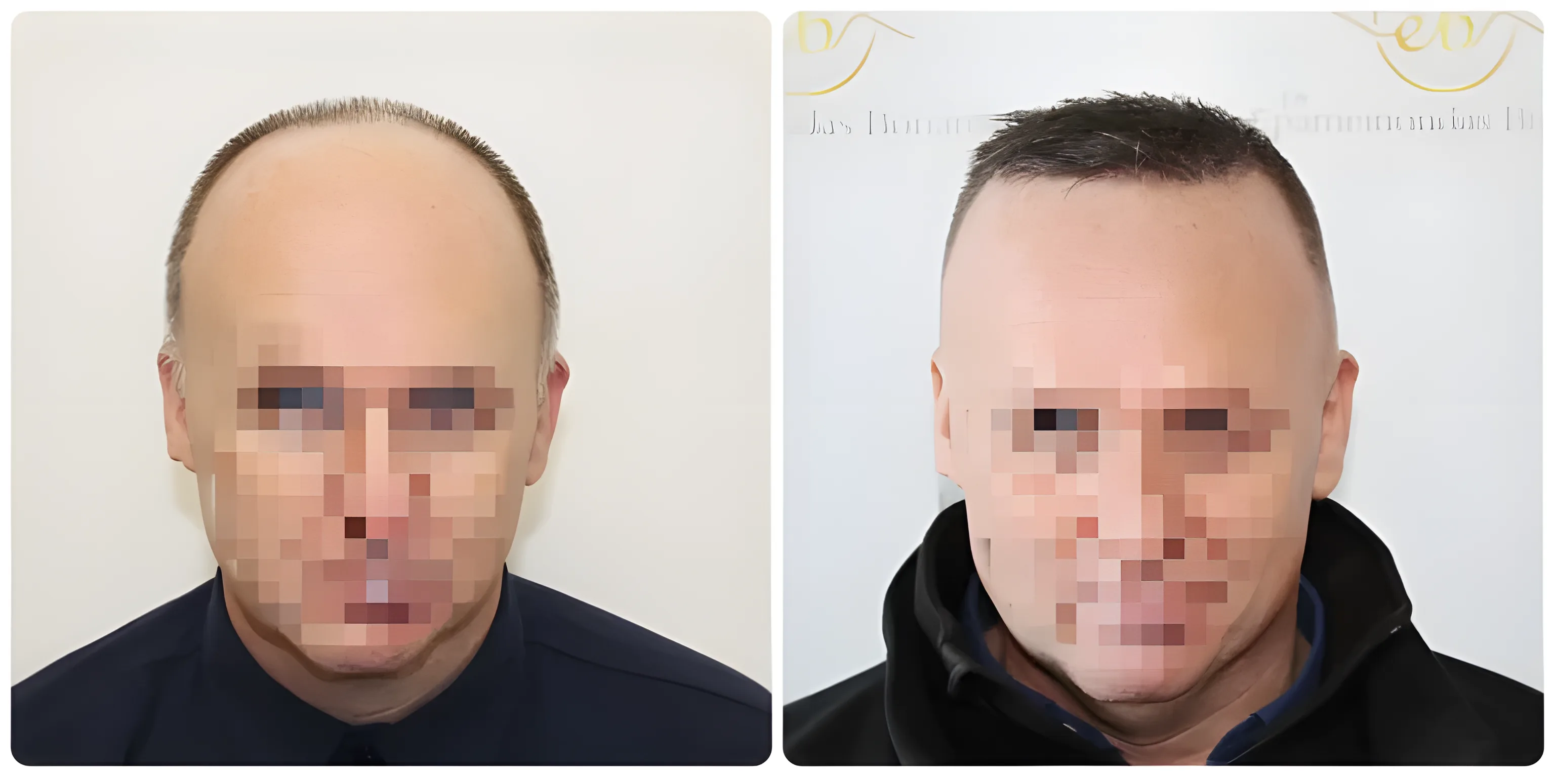 FUE hairline transplant — 2,000 grafts / 4,874 hairs