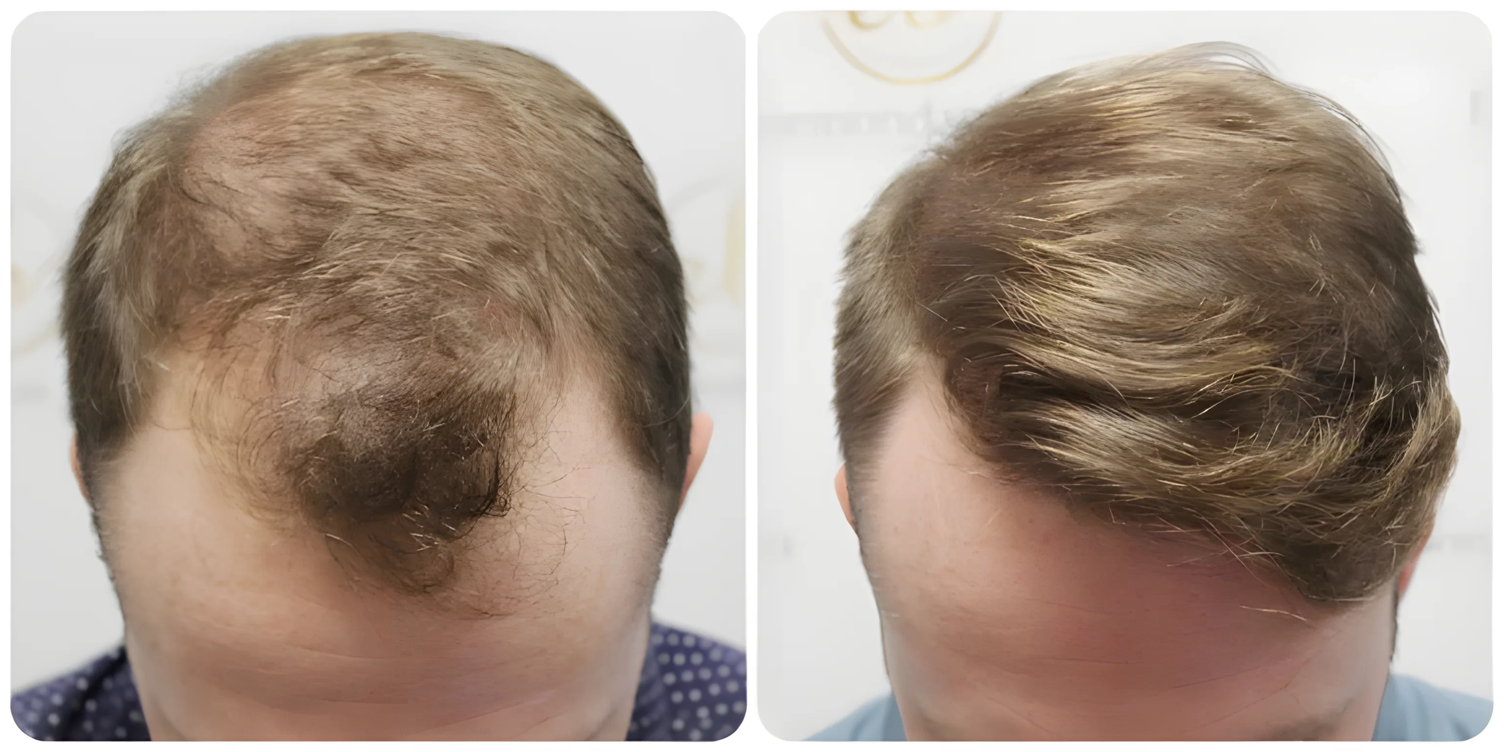 FUE hairline & crown restoration — Dr Bonaros