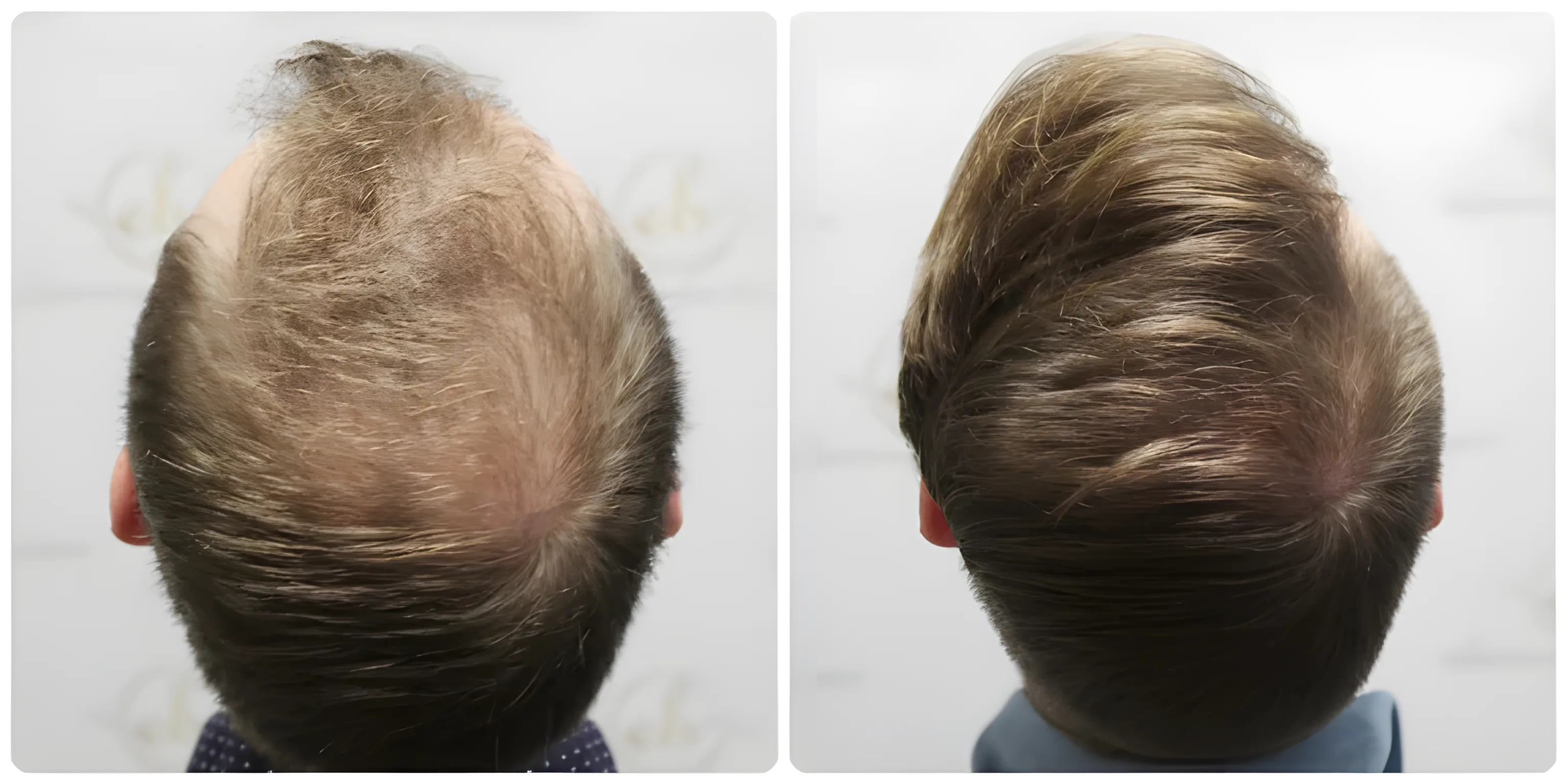 FUE crown & mid-scalp restoration — Dr Bonaros