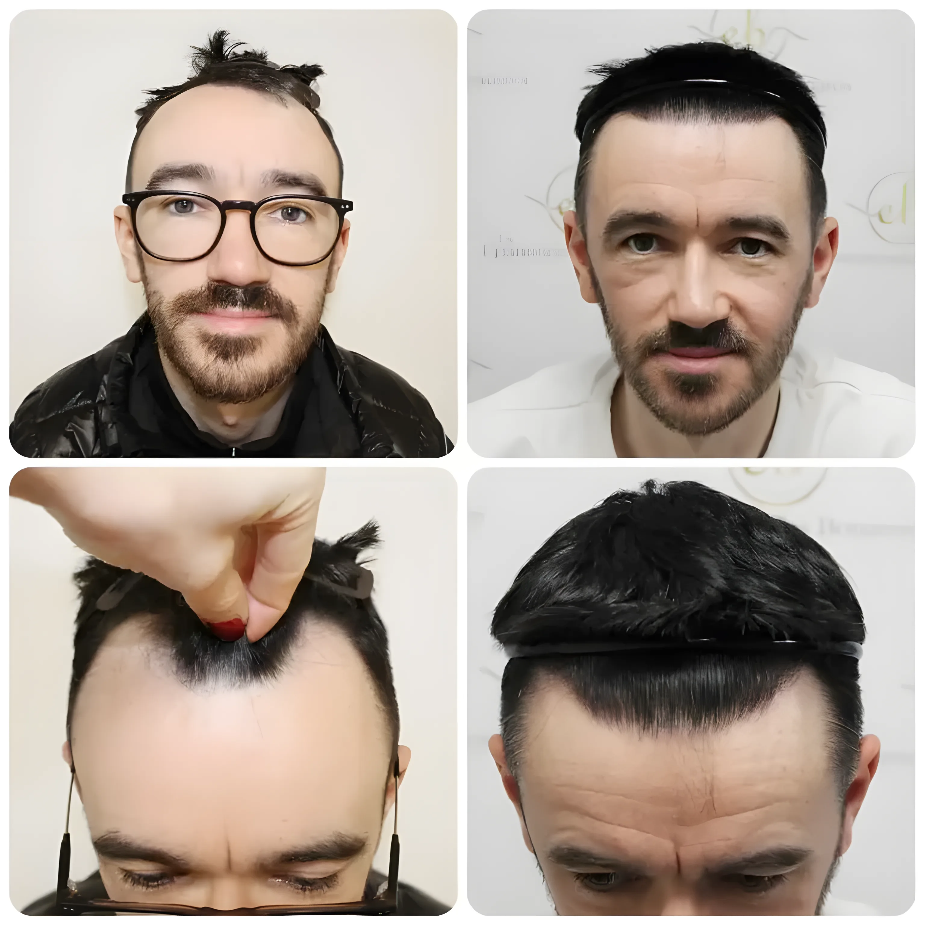 FUE receding hairline — 1,816 grafts / 4,033 hairs