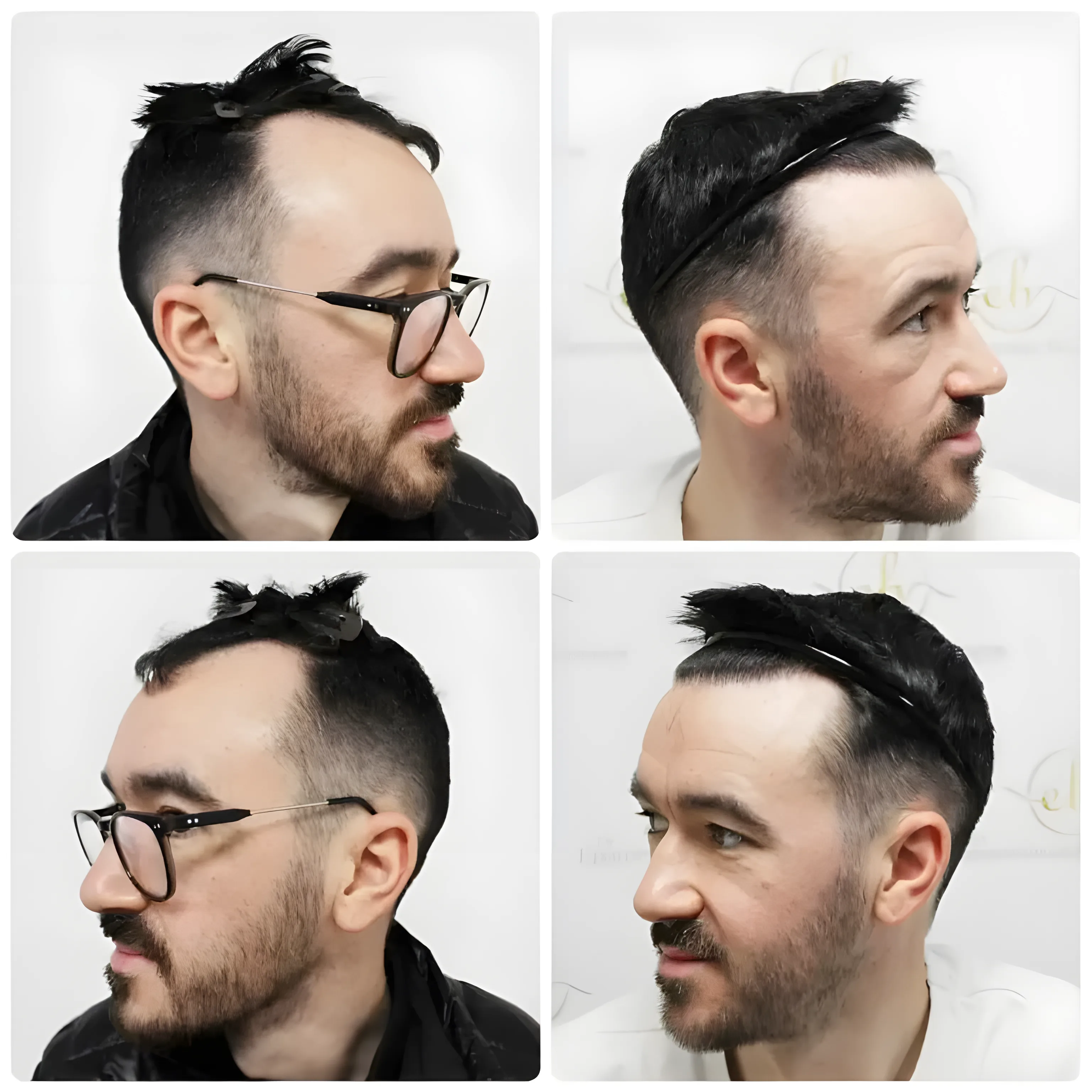 FUE receding hairline — 1,816 grafts / 4,033 hairs