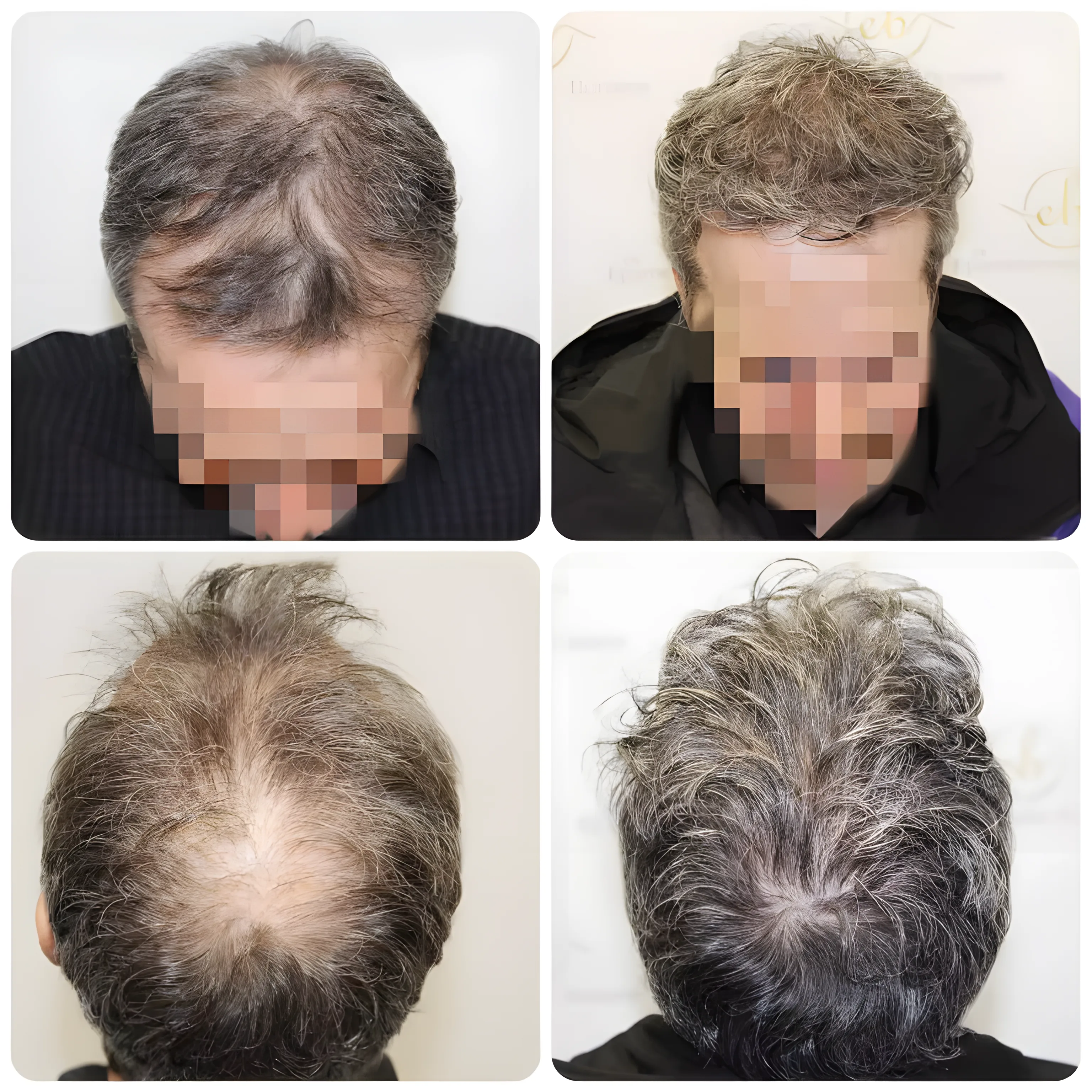FUE crown, mid-scalp & frontal — 3,595 grafts / 7,550 hairs