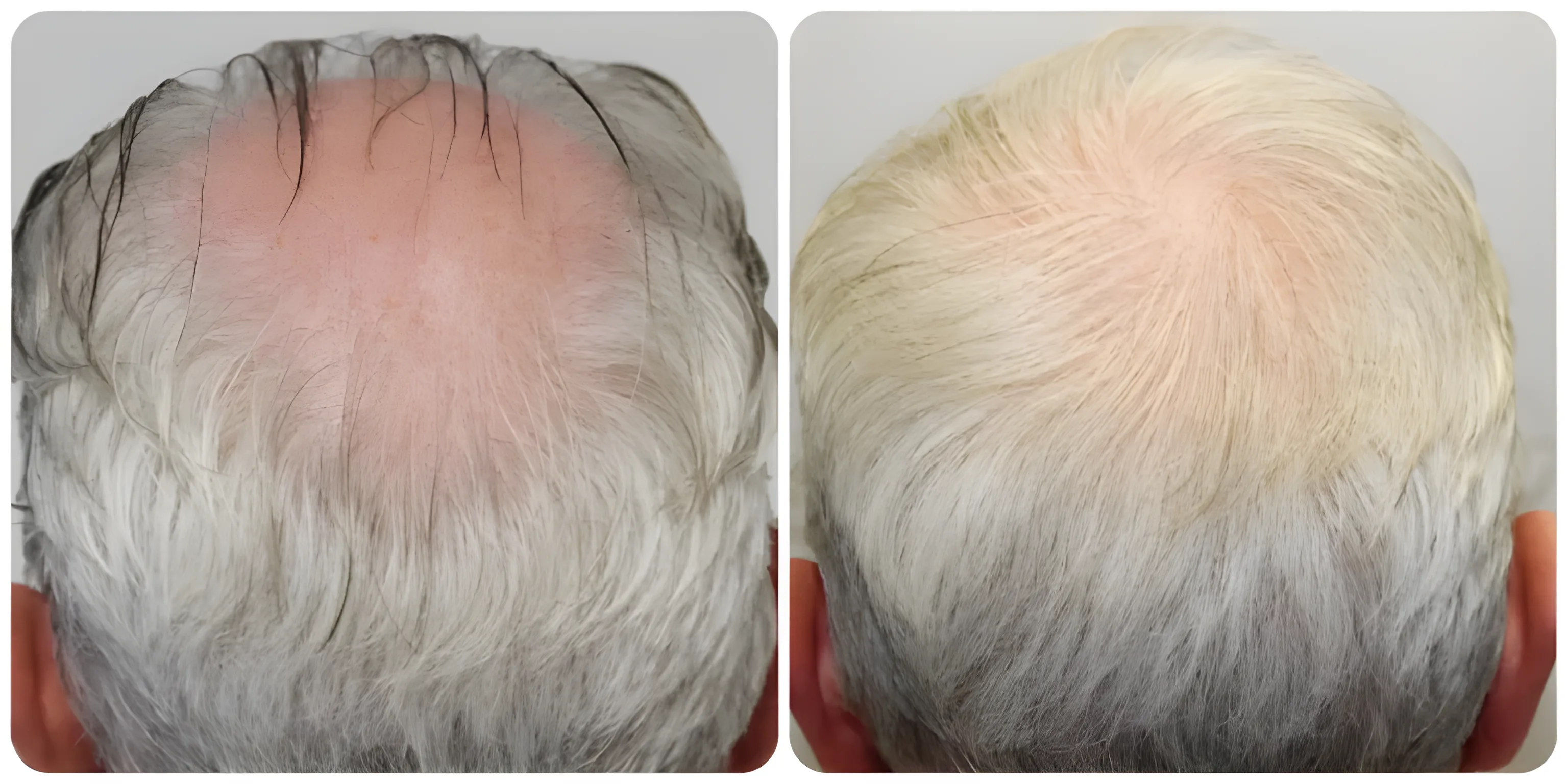 FUE crown transplant — 1,611 grafts / 3,916 hairs