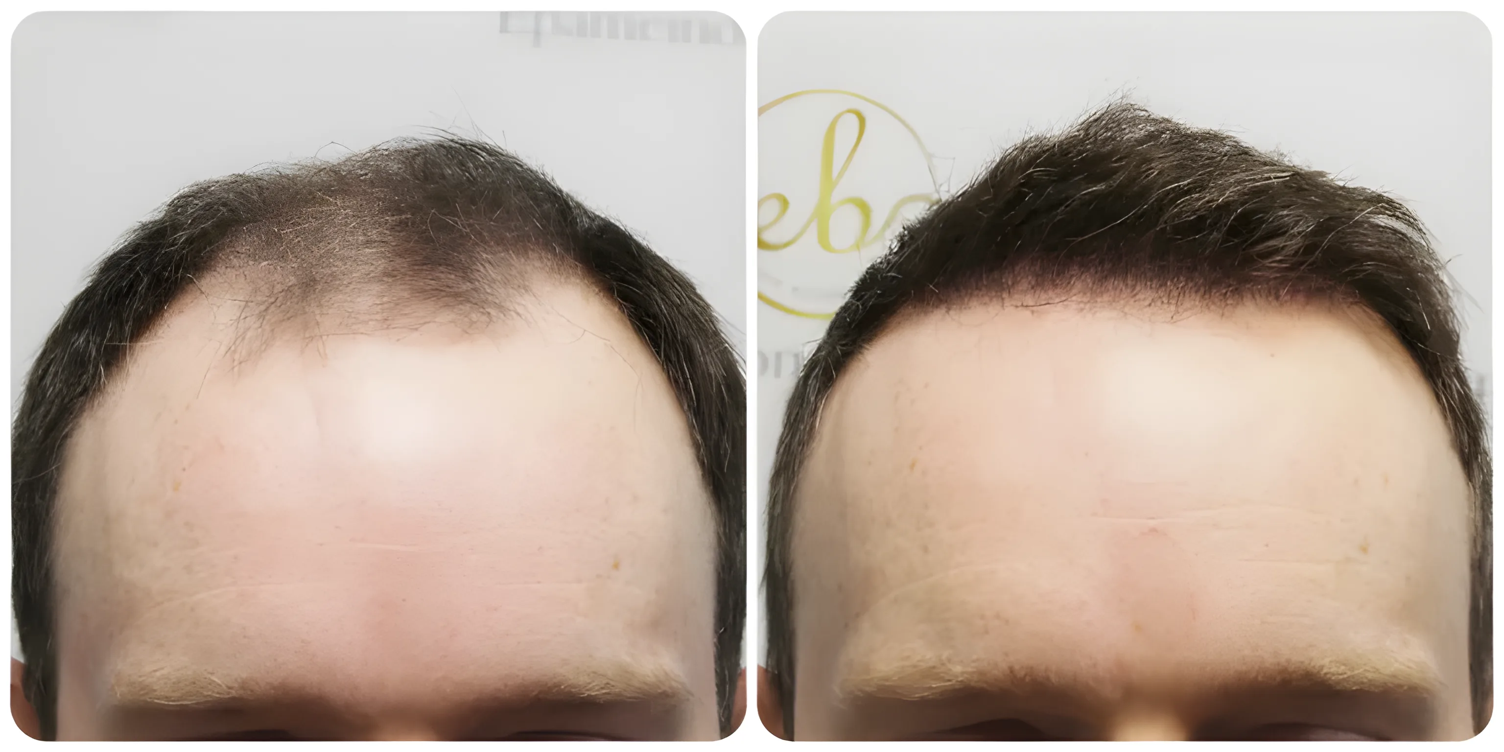 FUE hairline & mid-scalp — 4,146 grafts / 11,044 hairs