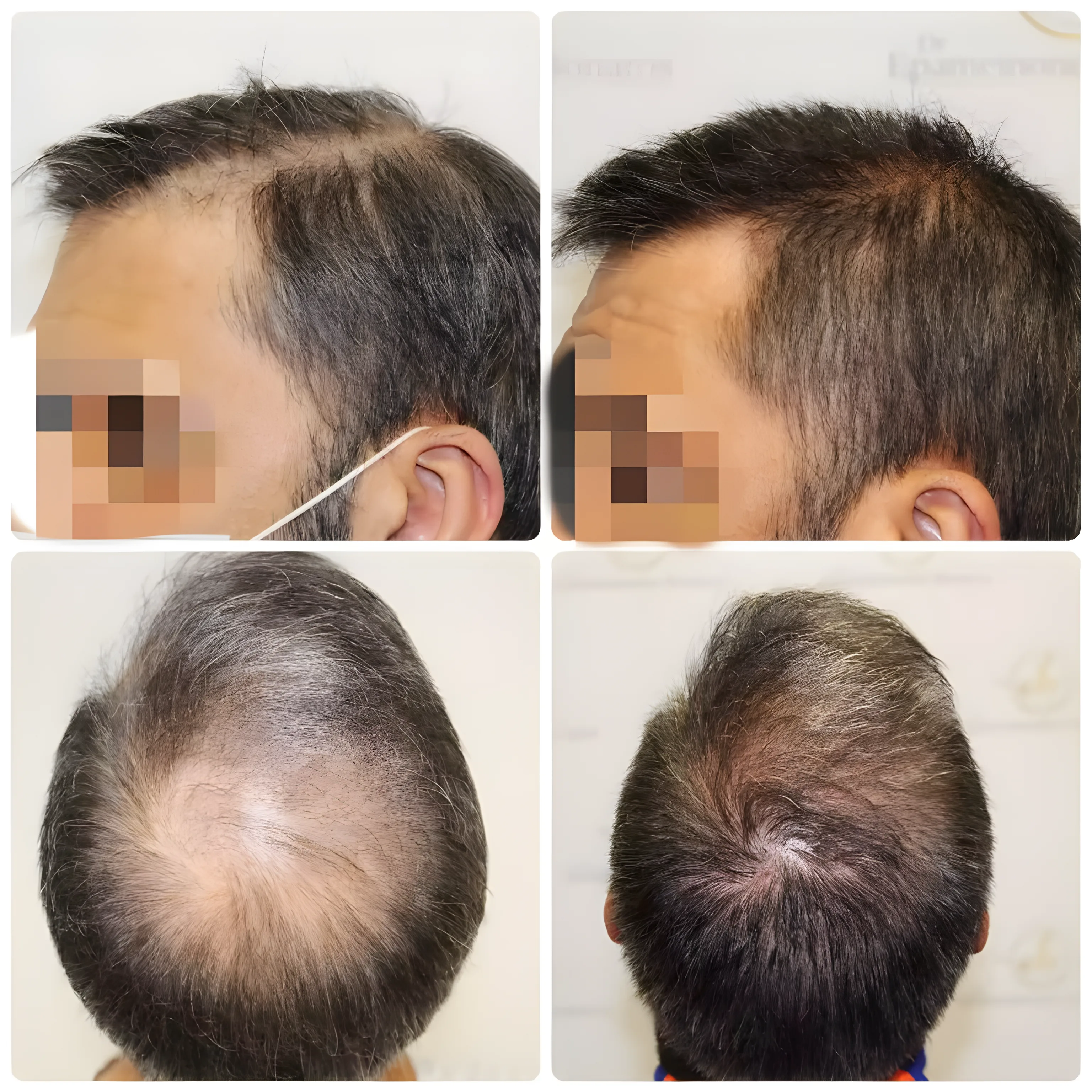 FUE crown & parting — 2,500 grafts