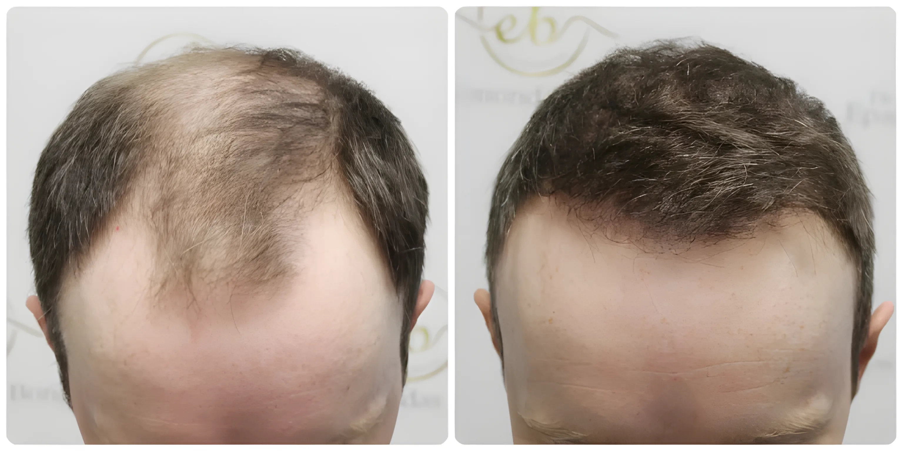 FUE hairline & mid-scalp — 4,146 grafts / 11,044 hairs