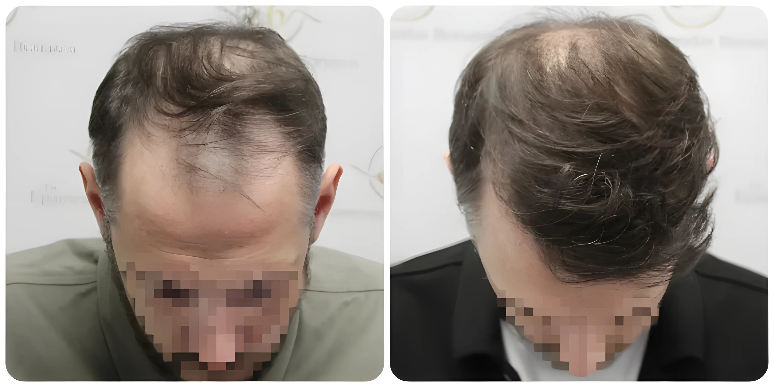 FUE hairline transplant — 2,122 grafts / 5,675 hairs