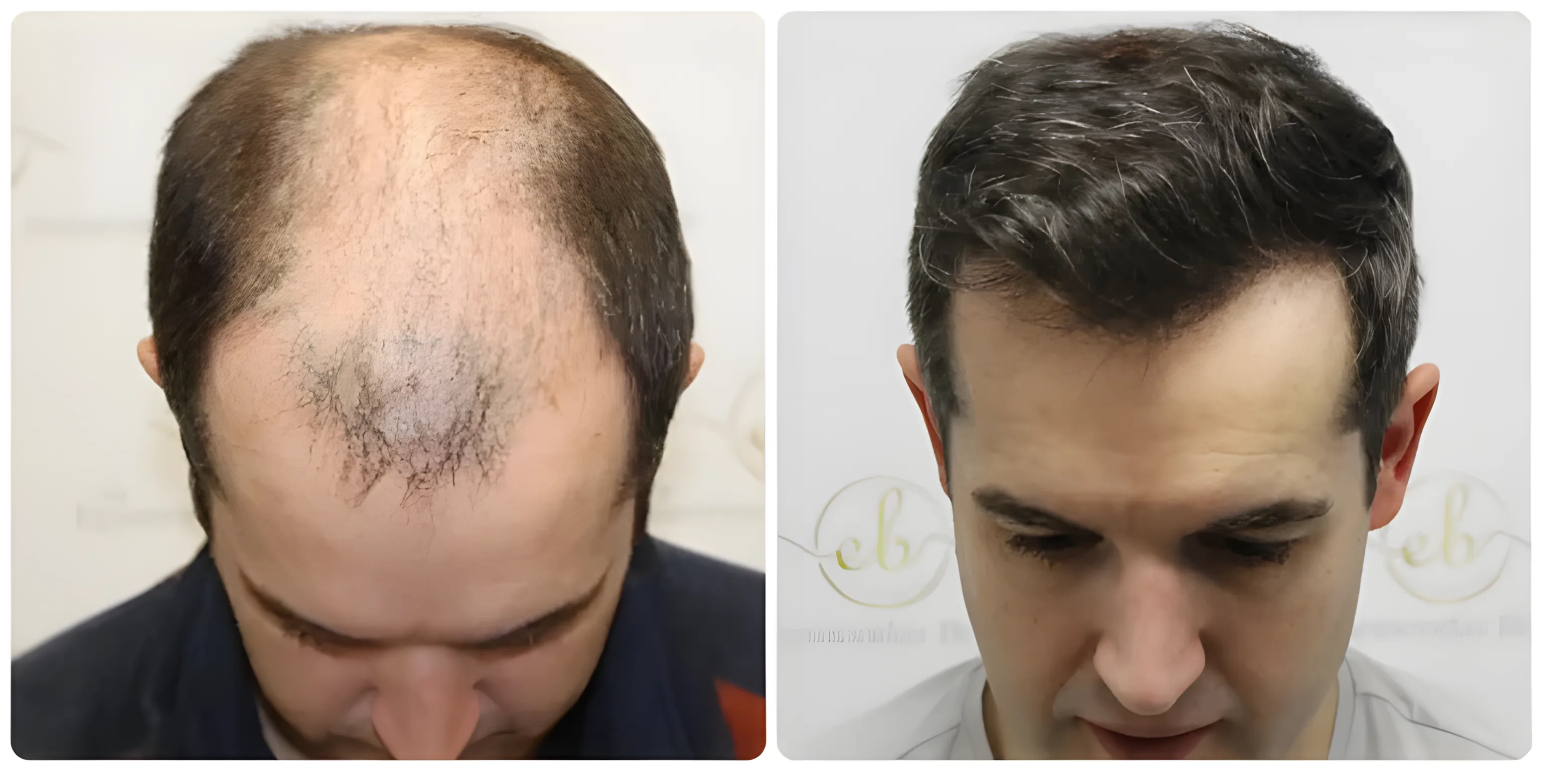 FUE hair transplant — 4,033 grafts / 8,024 hairs