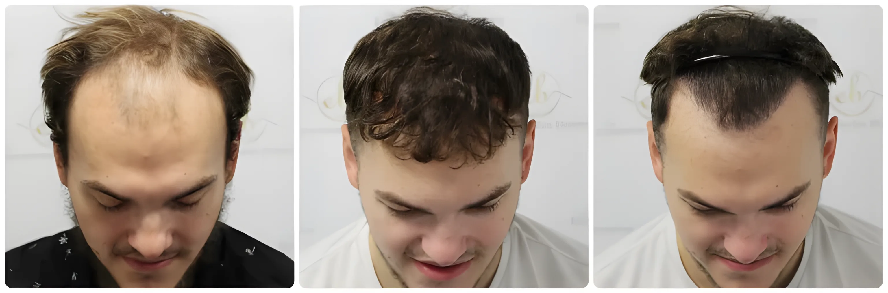 FUE receding hairline — 2,003 grafts / 4,390 hairs