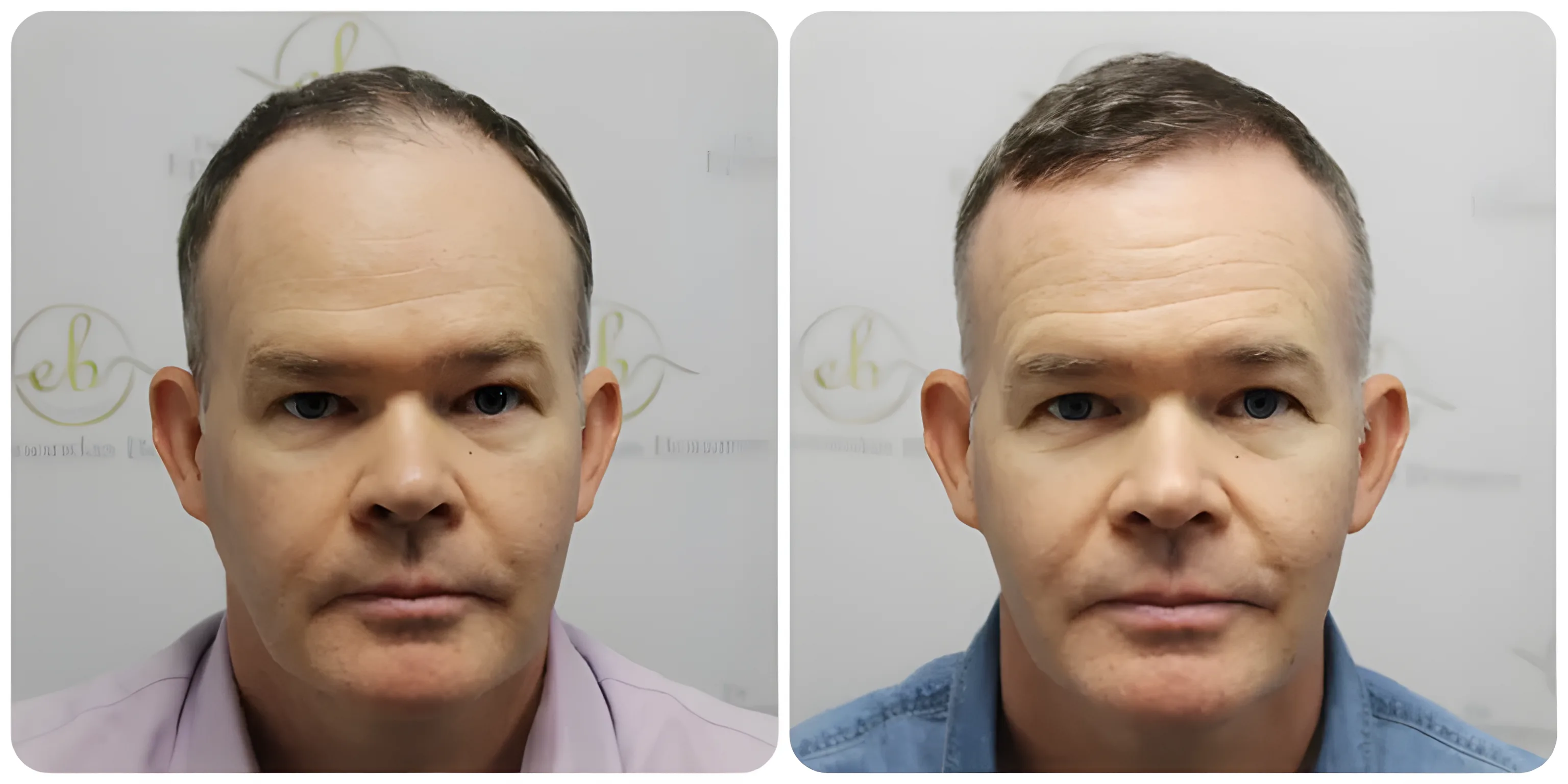 FUE front & mid-scalp rejuvenation — Dr Bonaros