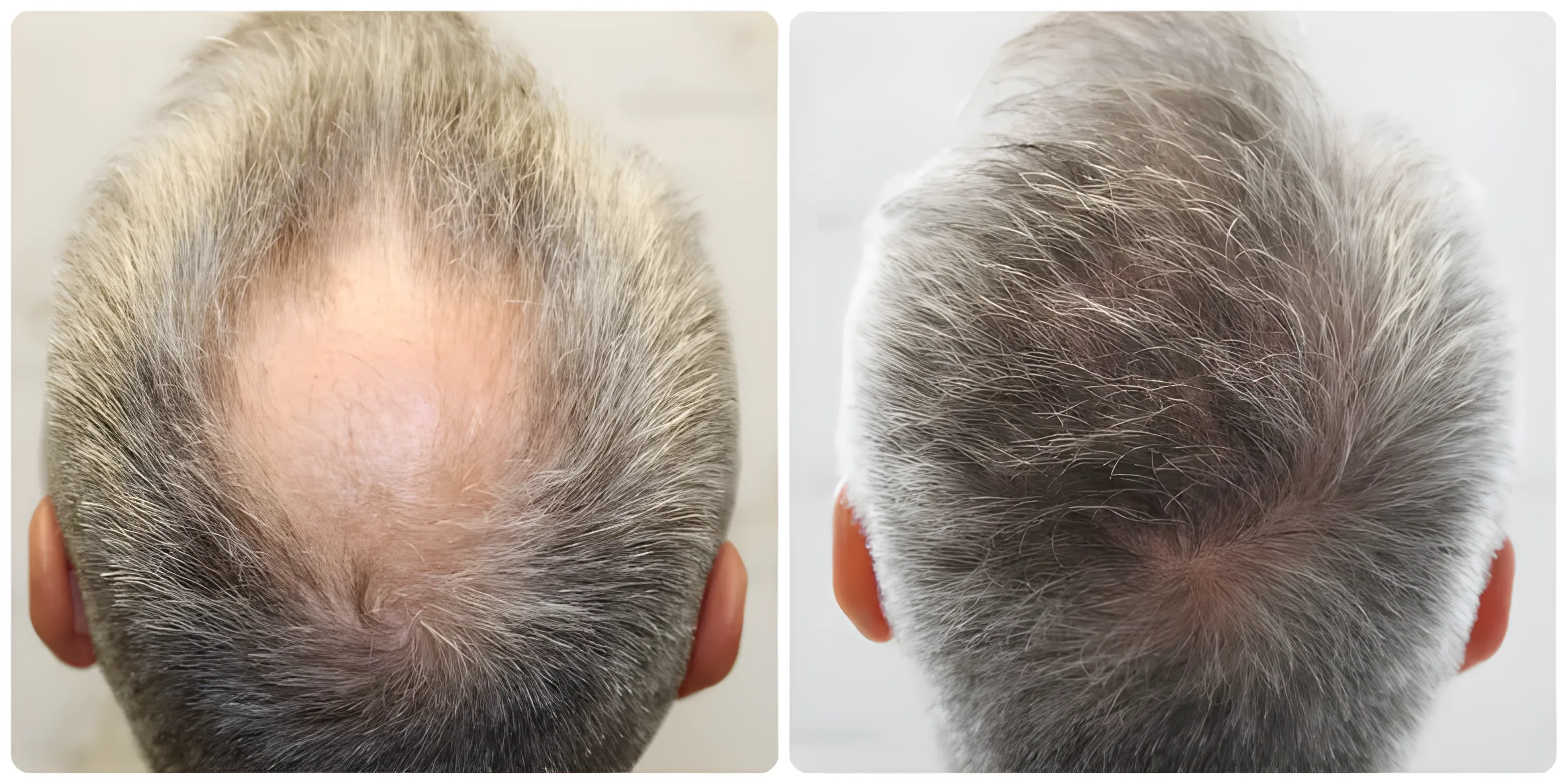 FUE crown transplant — 1,858 grafts / 4,335 hairs