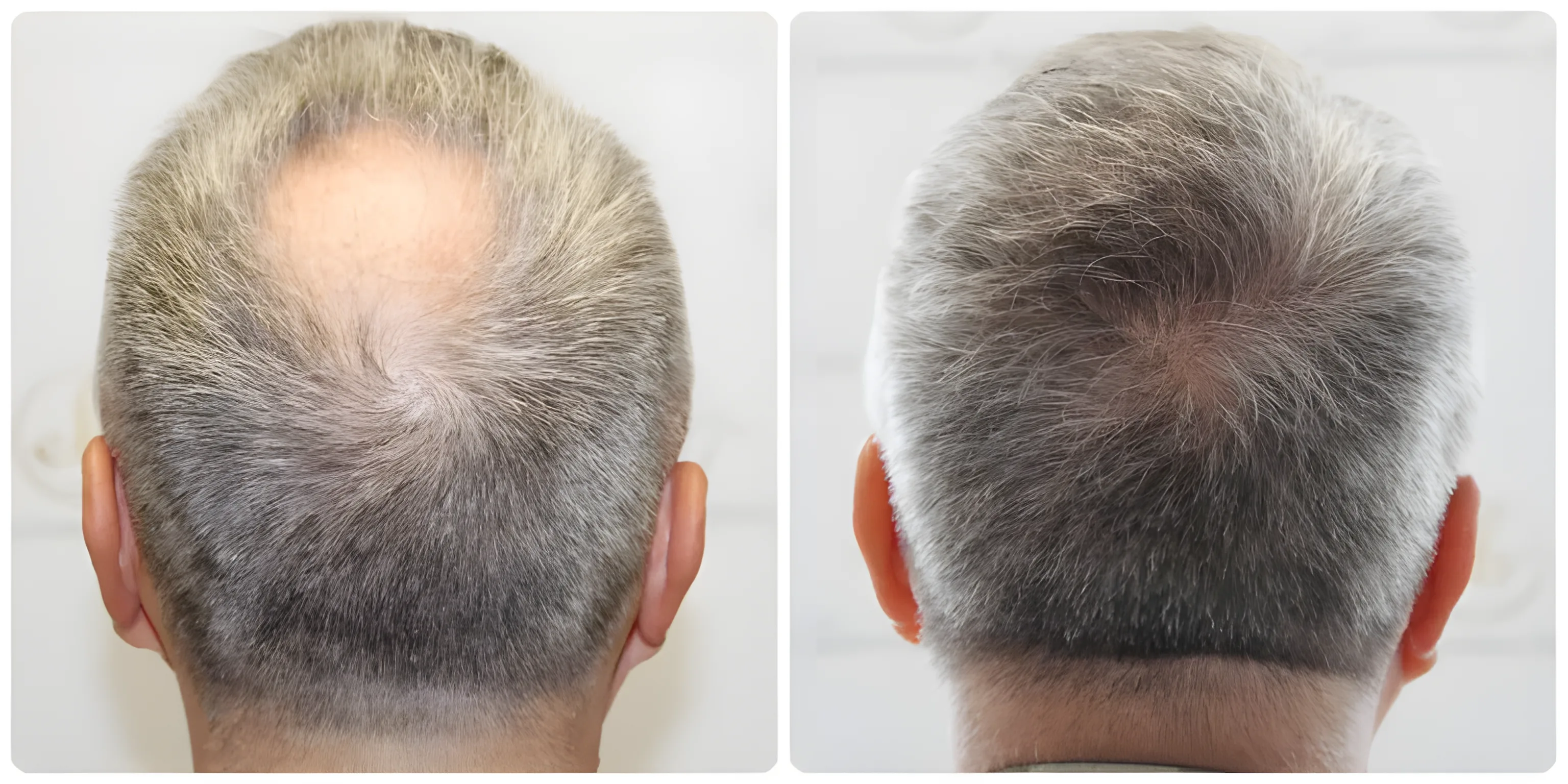 FUE crown transplant — 1,858 grafts / 4,335 hairs