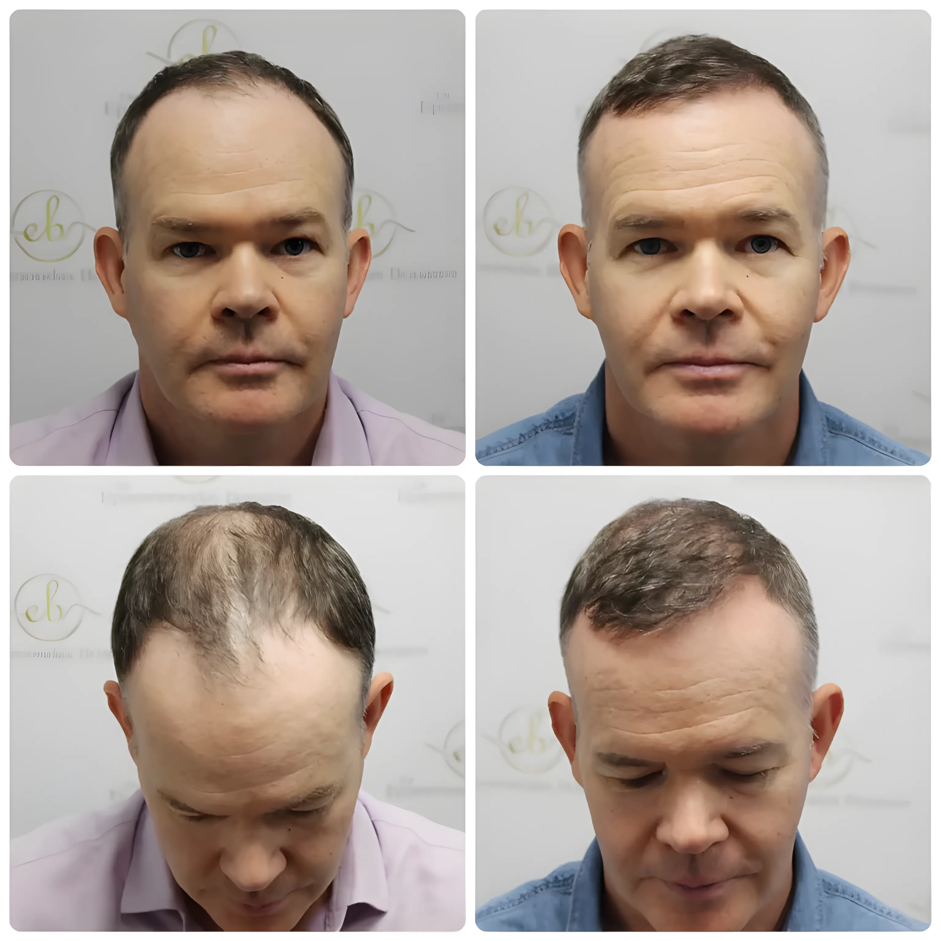FUE receding hairline — 1,990 grafts / 3,893 hairs