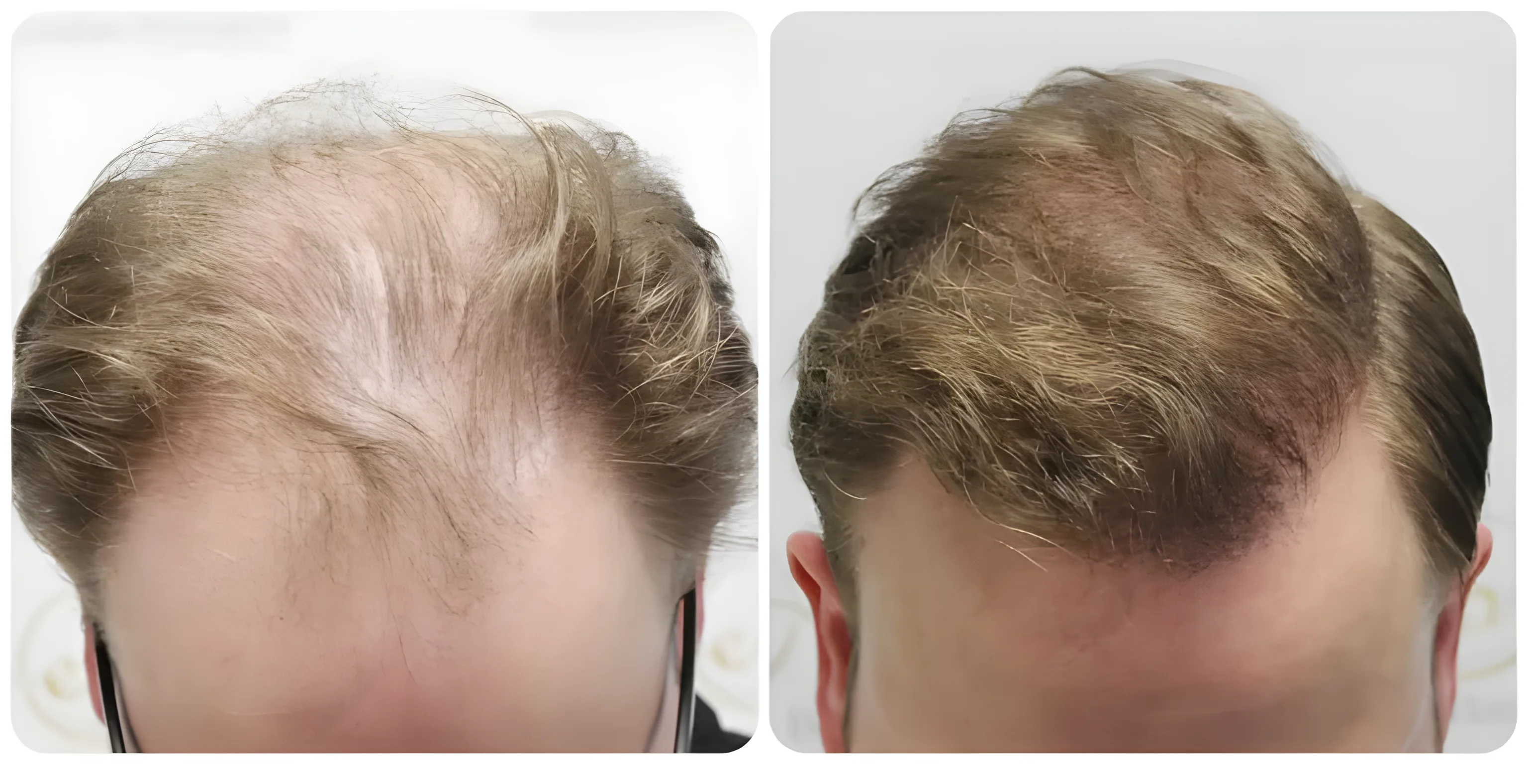 FUE hairline, mid-scalp & crown — 4,081 grafts / 8,253 hairs