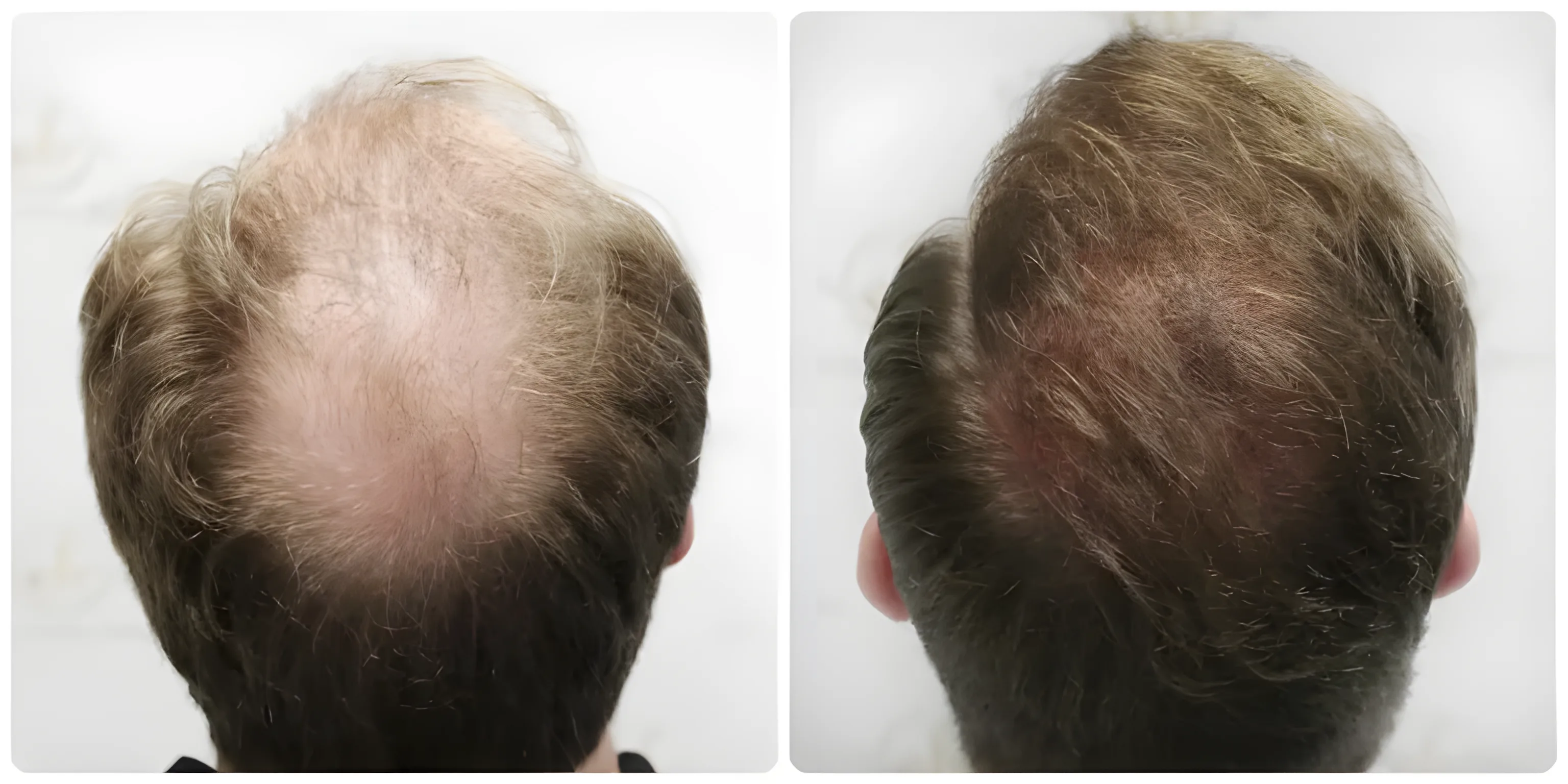 FUE hairline & crown restoration — Dr Bonaros